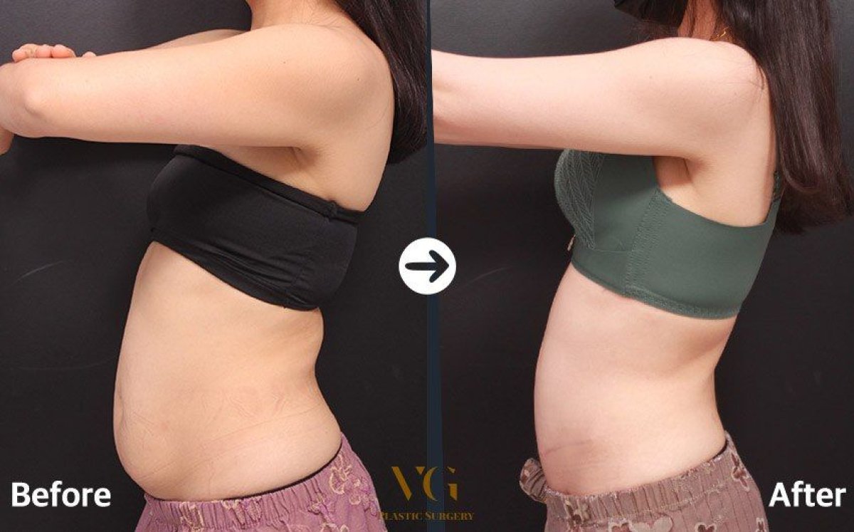نتائج شفط الدهون 360 قبل وبعد في VG Plastic Surgery – خصر أنحف بشكل واضح