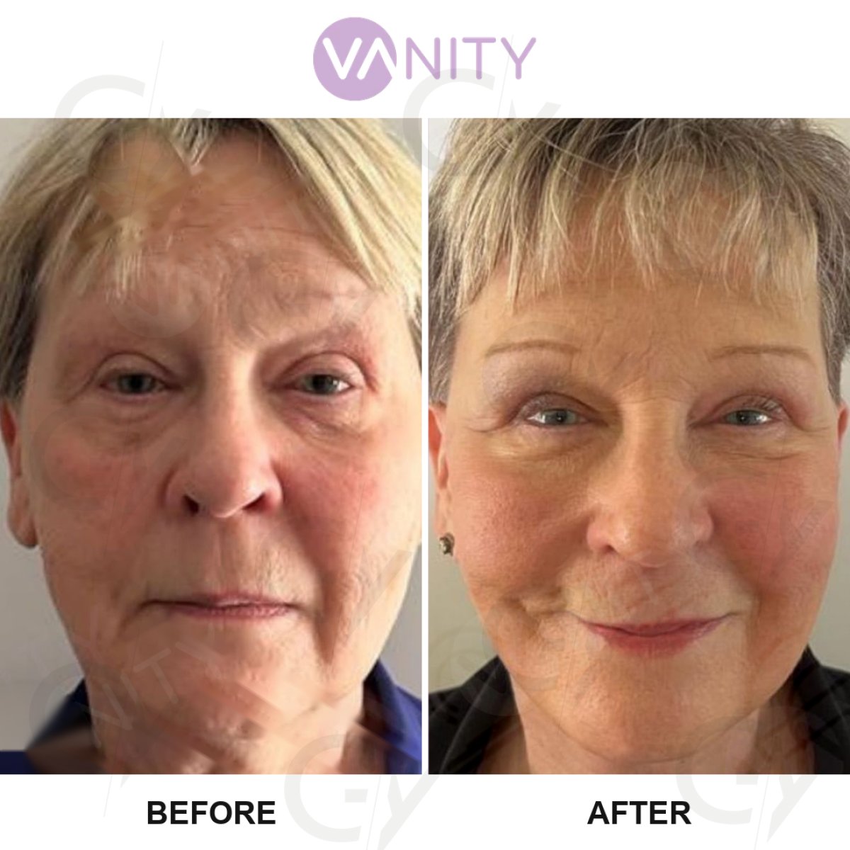 Facelift before and after results at Vanity Cosmetic Surgery Hospital, visible facial rejuvenation