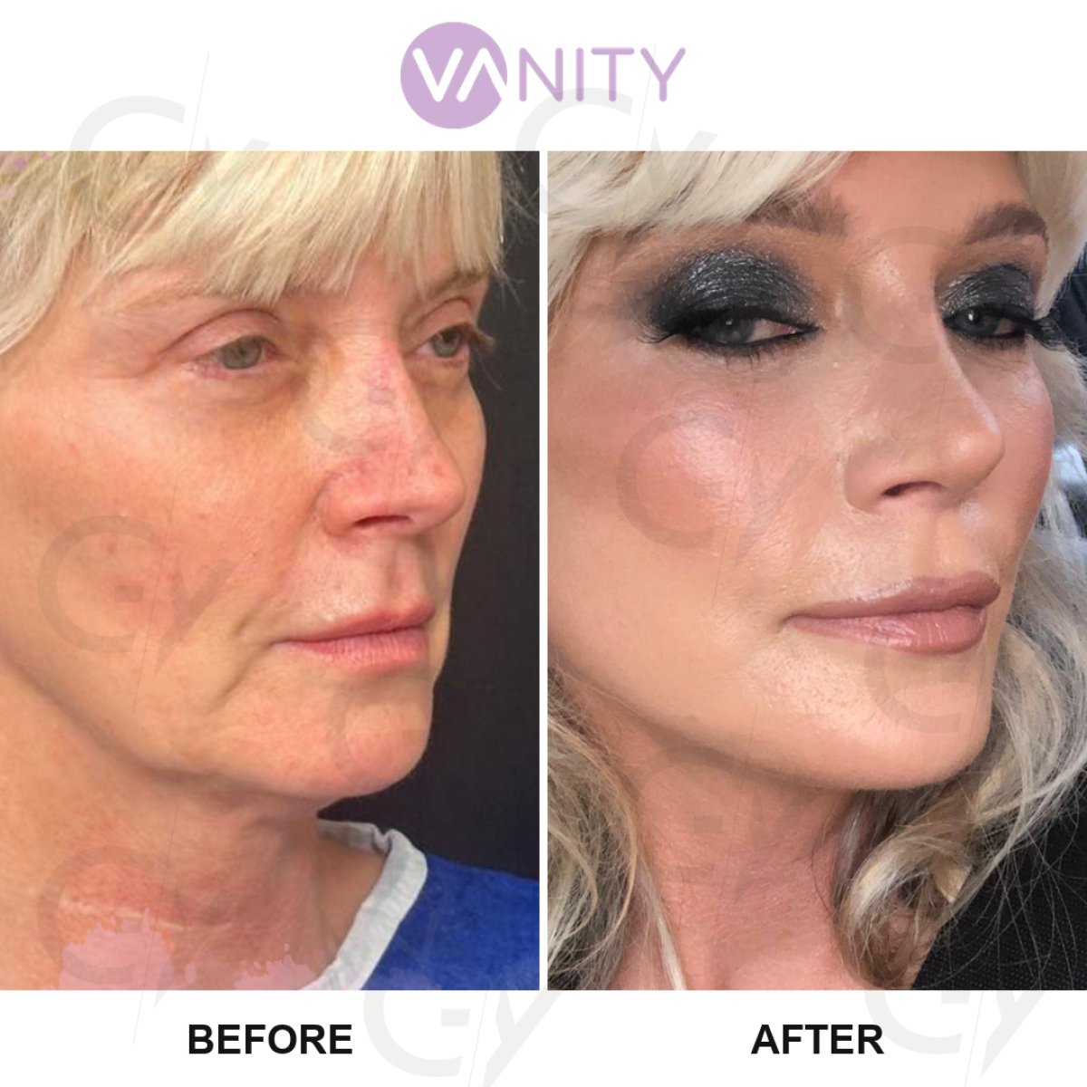 Resultados de lifting facial antes y después en Vanity Cosmetic Surgery Hospital, rejuvenecimiento