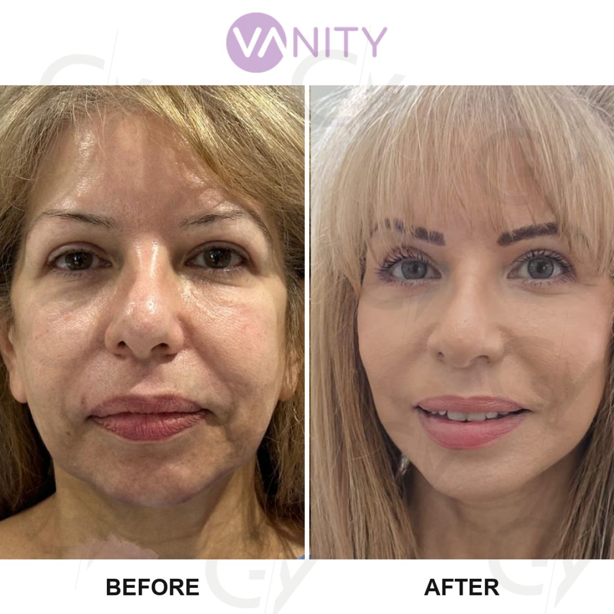 Resultados de lifting facial antes y después en Vanity Cosmetic Surgery Hospital, rejuvenecimiento facial
