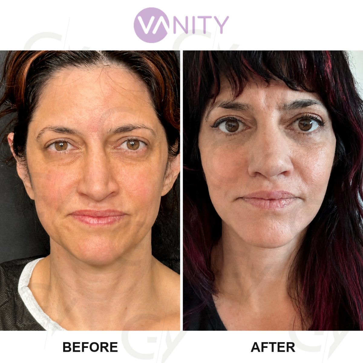Resultados de lifting facial antes y después en Vanity Cosmetic Surgery Hospital, rejuvenecimiento