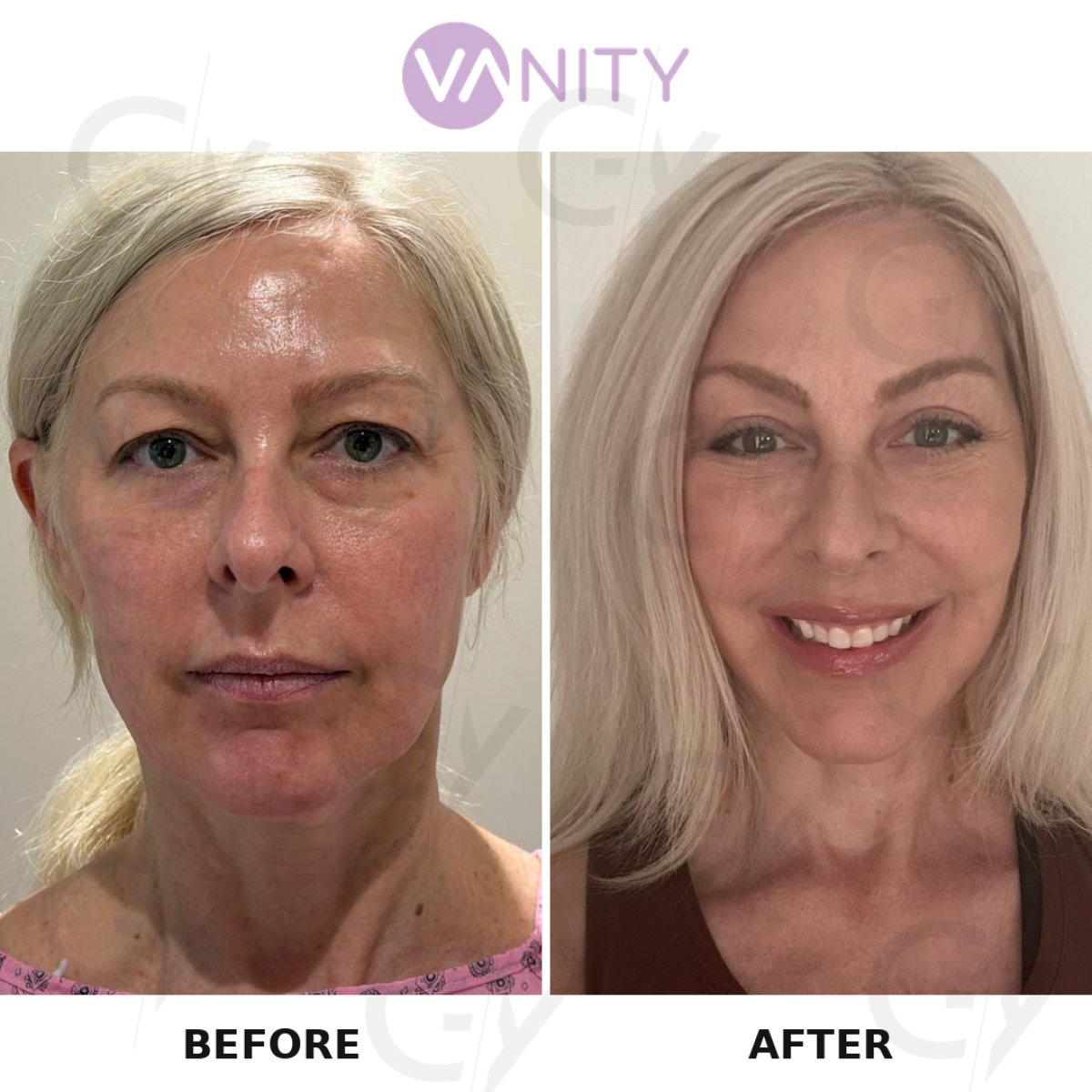 Resultados de lifting facial antes y después en Vanity Cosmetic Surgery Hospital, rejuvenecimiento