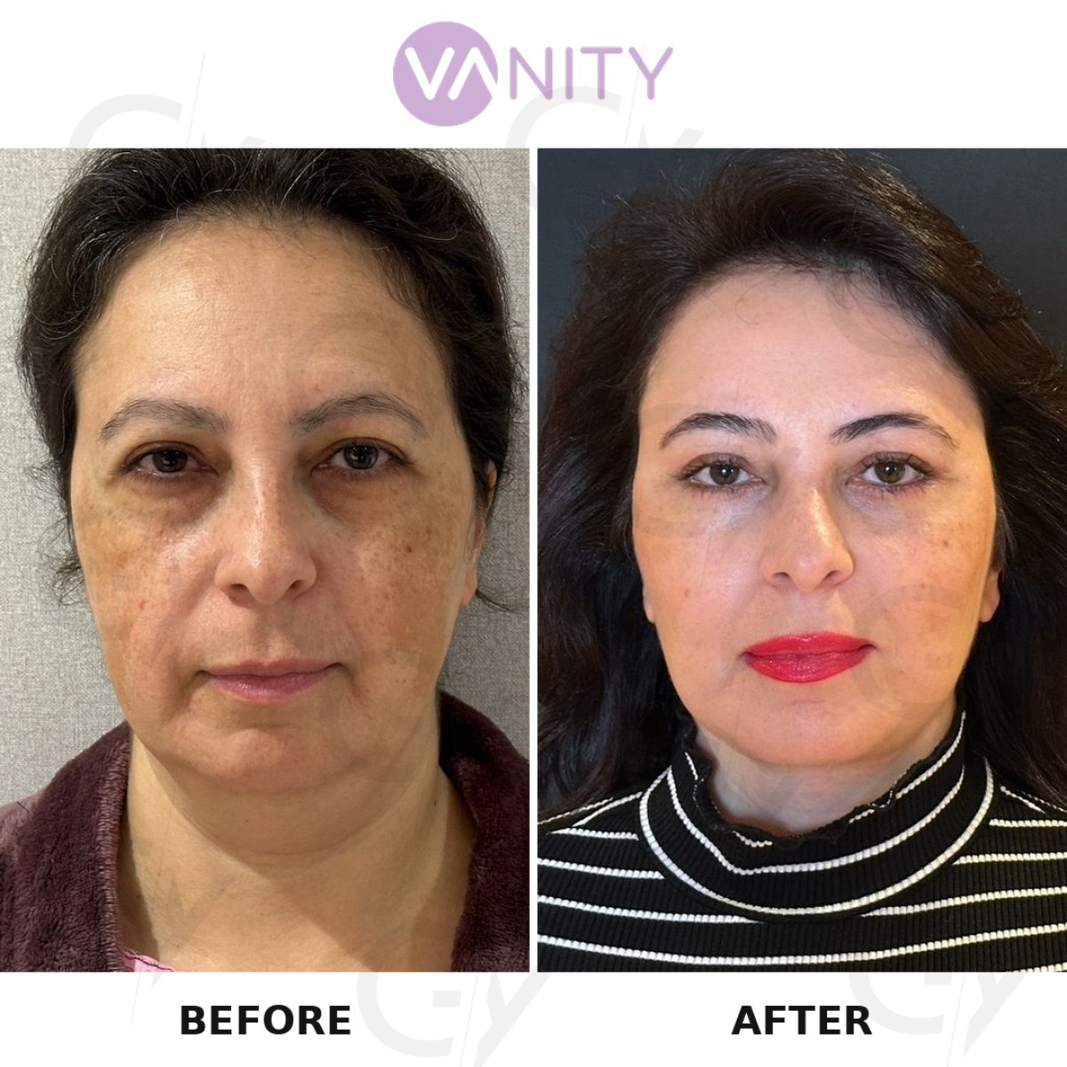 Resultados de lifting facial antes y después en Vanity Cosmetic Surgery Hospital, rejuvenecimiento visible