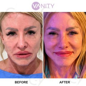 Standard Facelift with Dr. Güray Yeşiladalı - photo 6