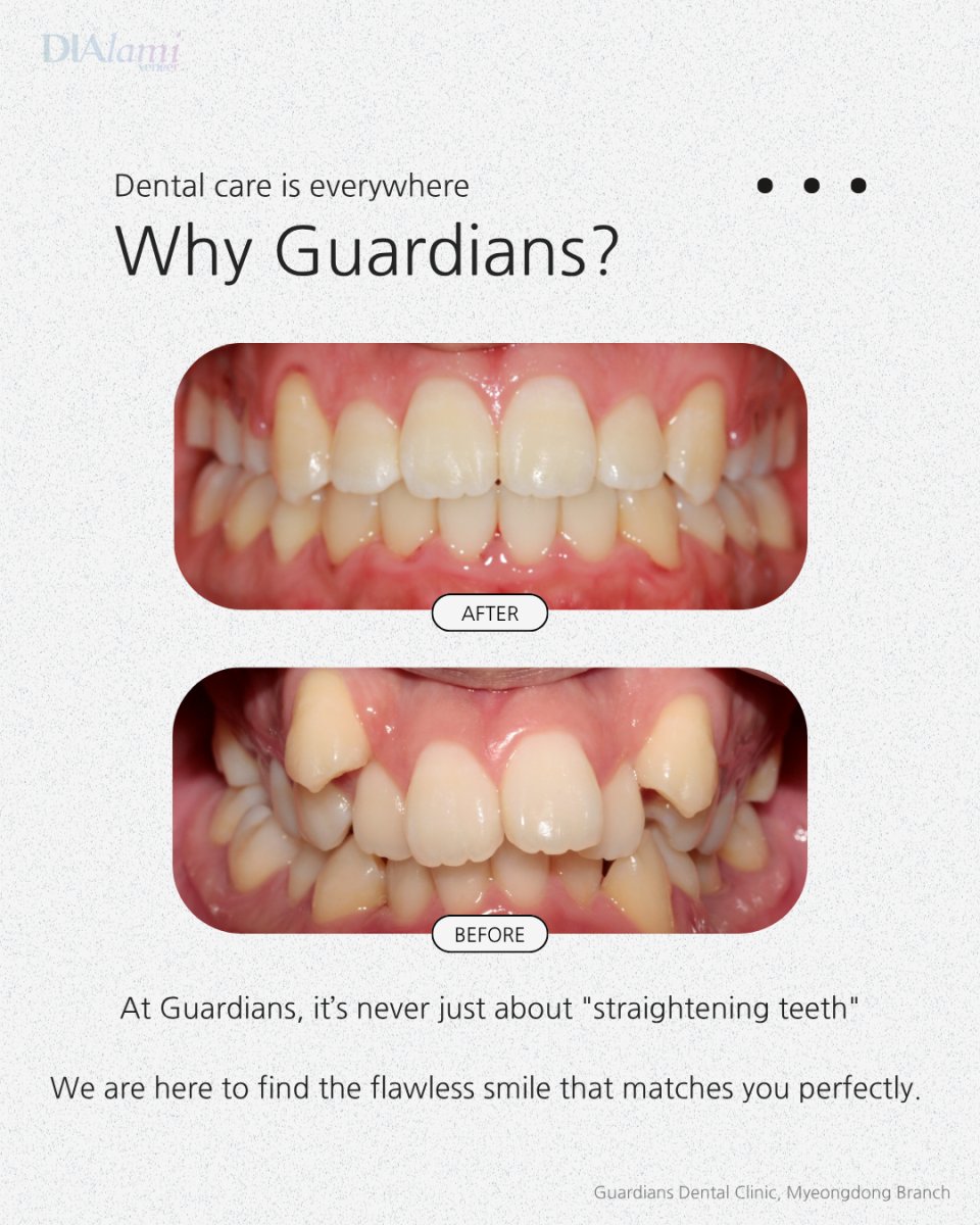 Before and after braces results at Guardians Dental Clinic – improved teeth alignment