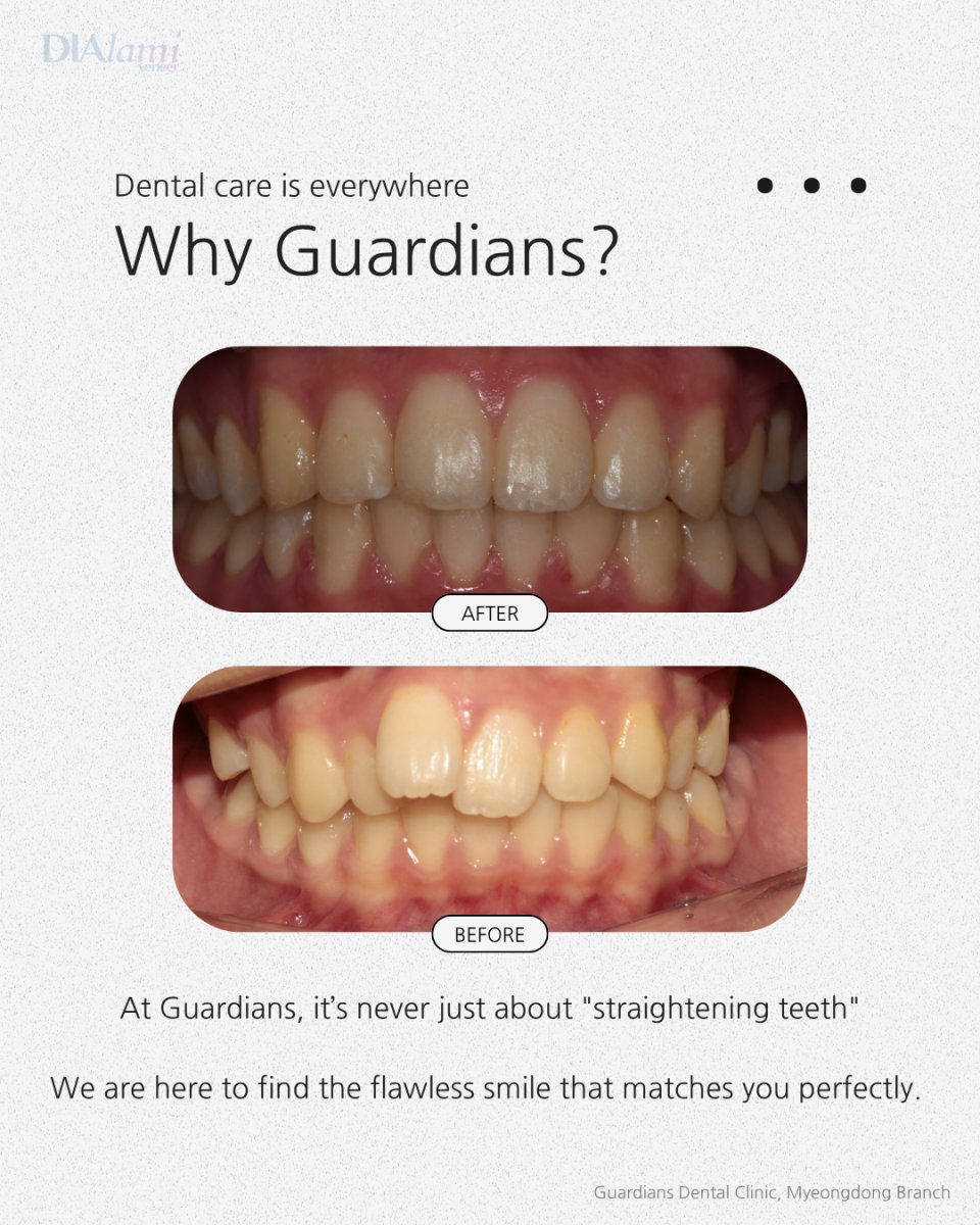نتائج قبل وبعد تقويم الأسنان في Guardians Dental Clinic – تحسين انتظام الأسنان