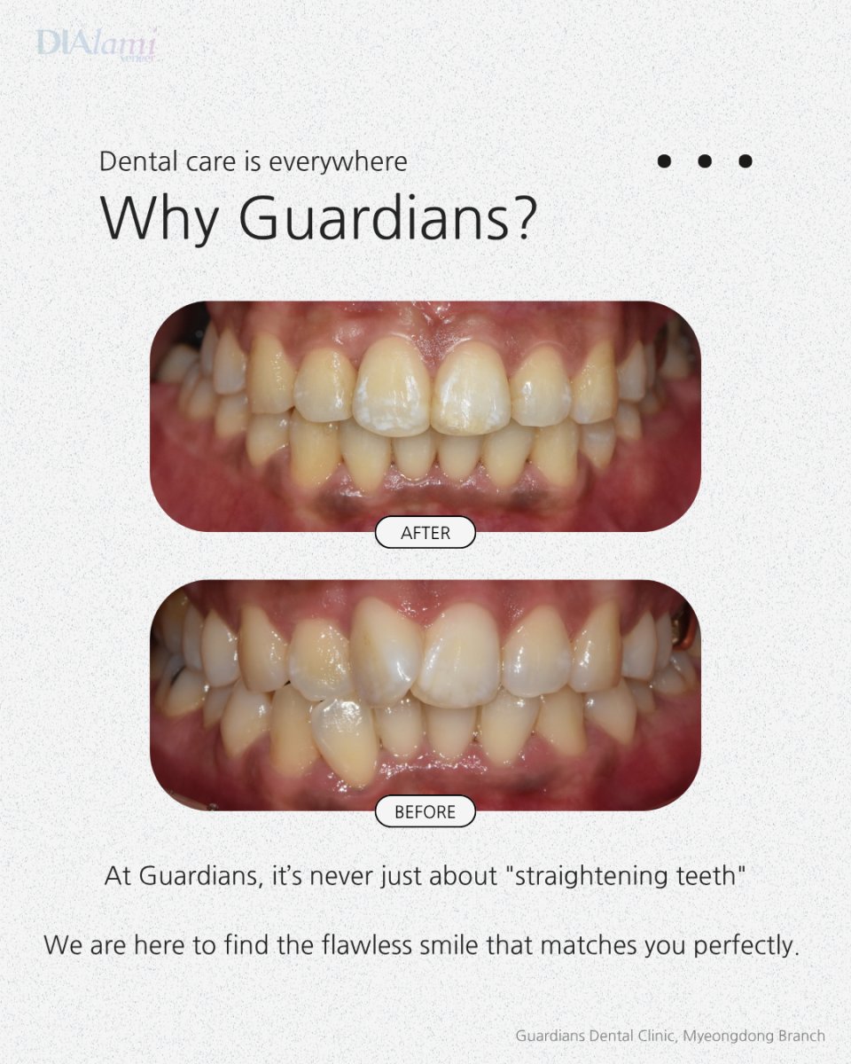 نتائج قبل وبعد تقويم الأسنان في Guardians Dental Clinic – أسنان أكثر استقامة وابتسامة محسنة