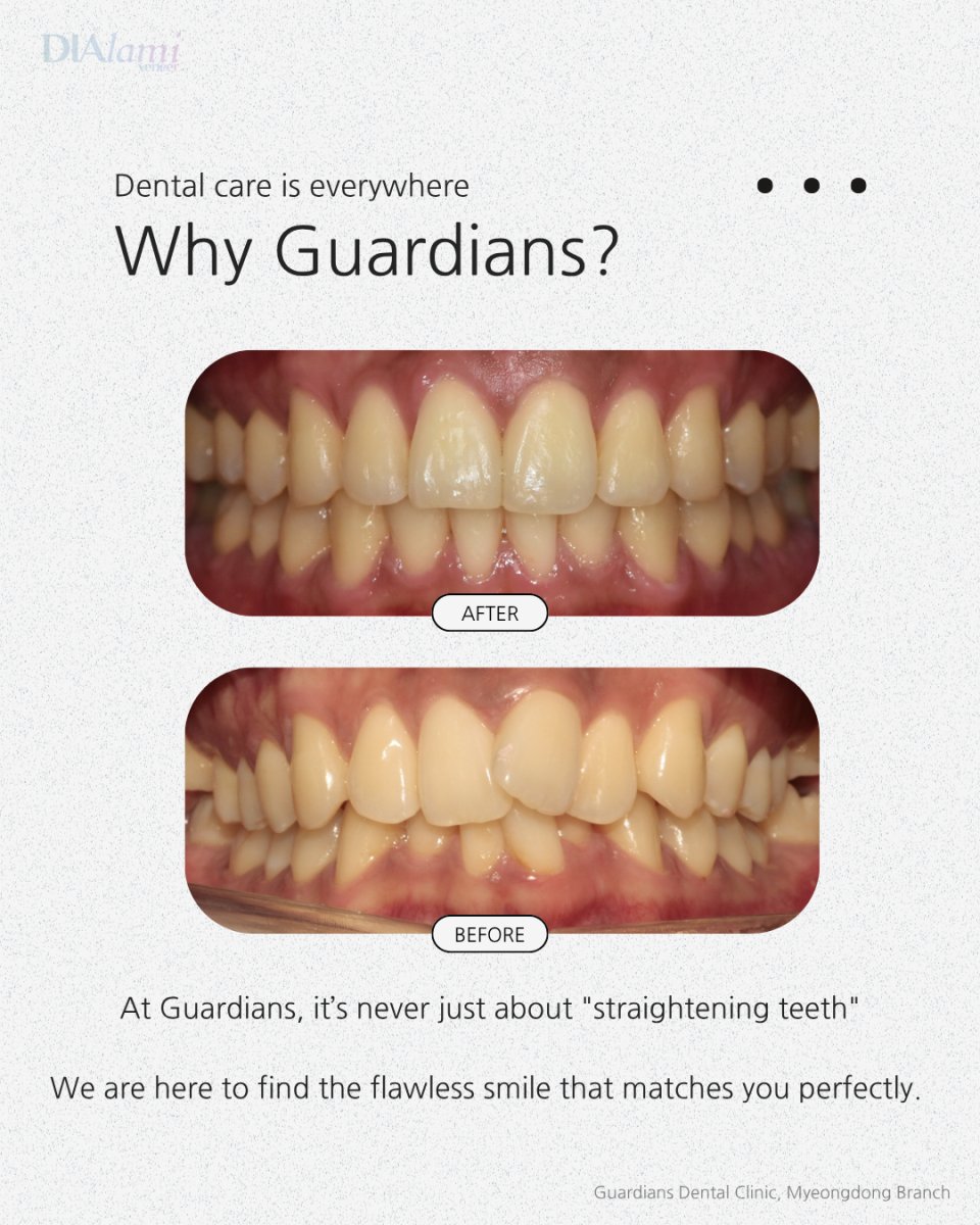 نتائج قبل وبعد تقويم الأسنان في Guardians Dental Clinic – تحسين انتظام الأسنان