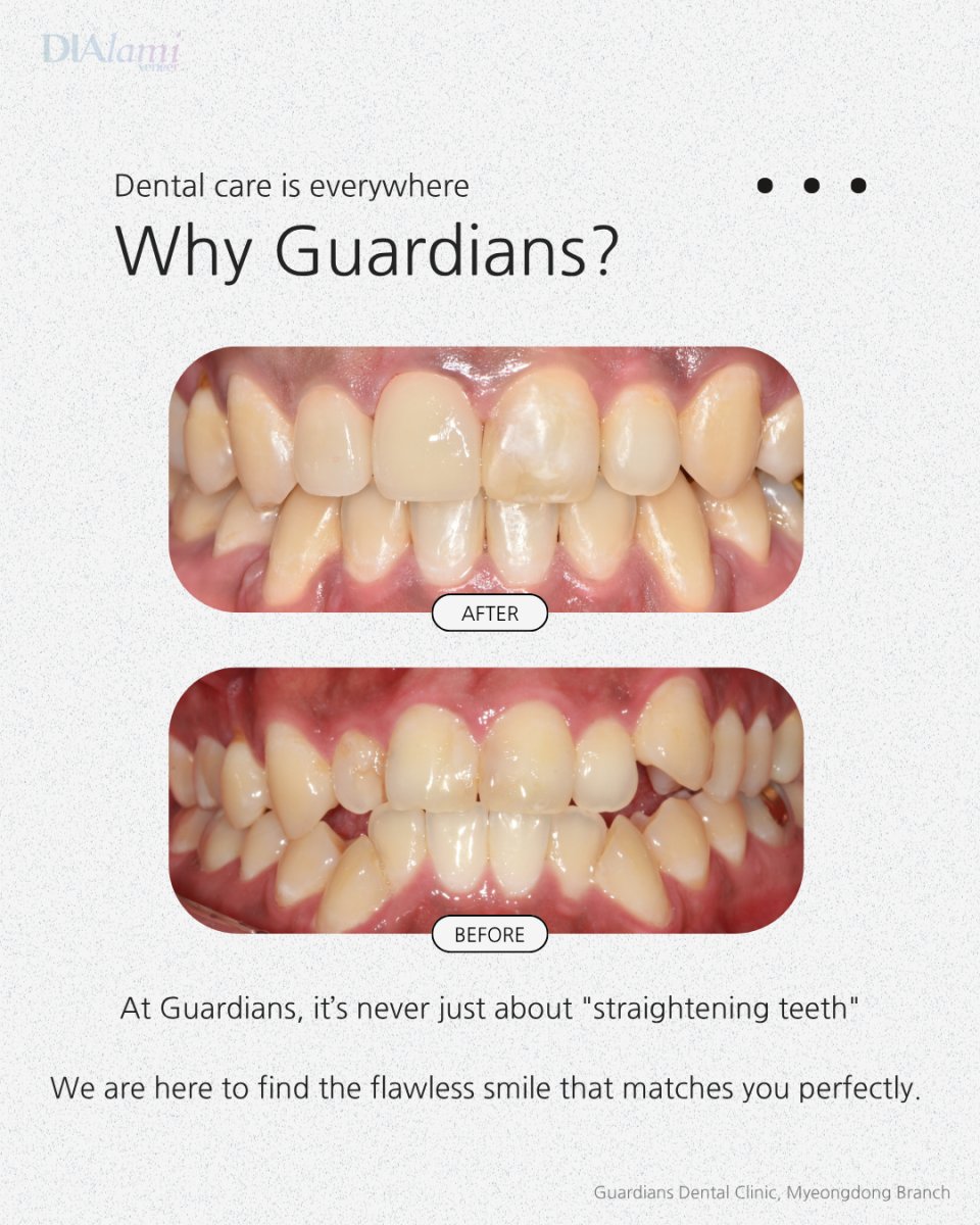 نتائج قبل وبعد تقويم الأسنان في Guardians Dental Clinic – تحسين انتظام الأسنان