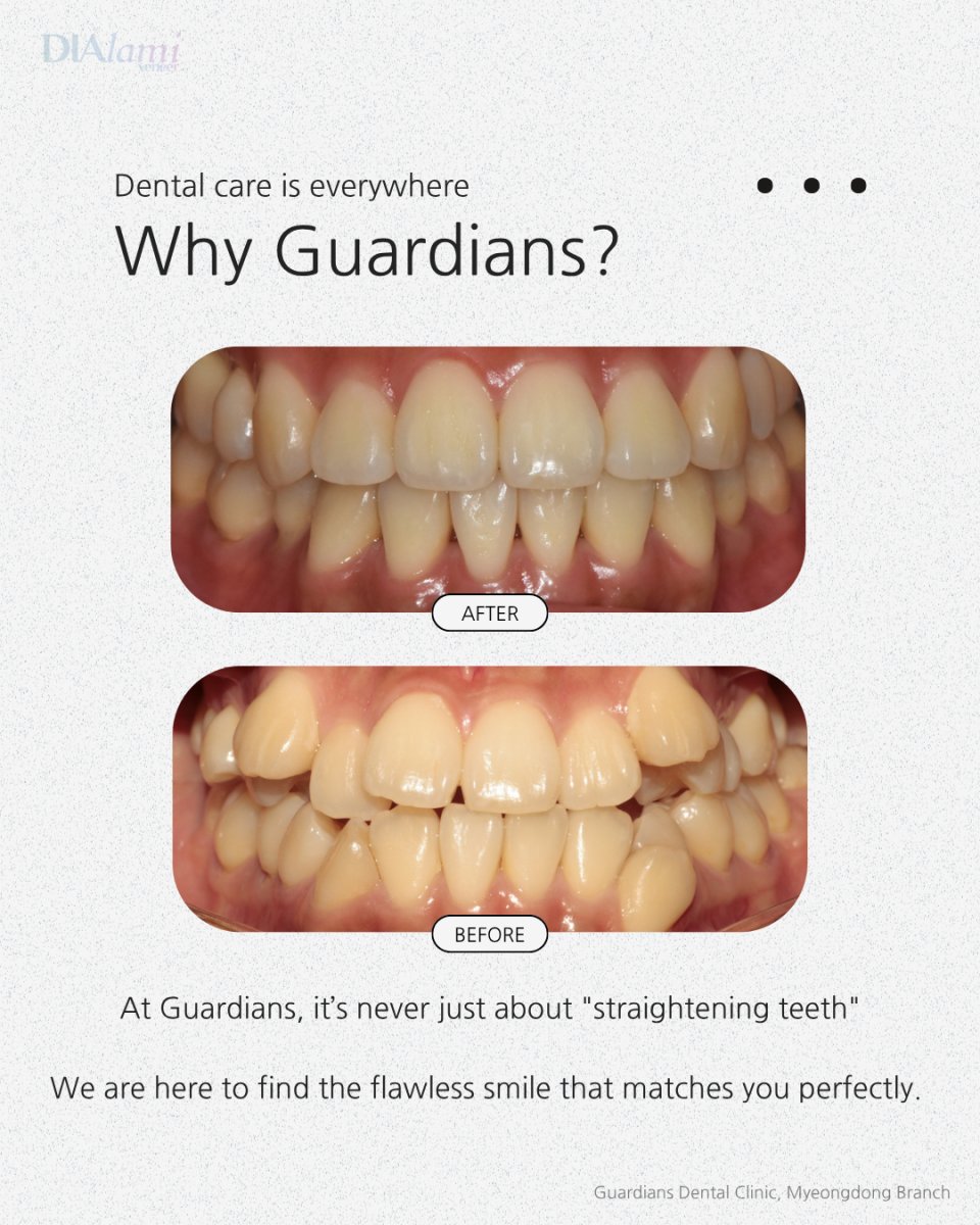 نتائج قبل وبعد تقويم الأسنان في Guardians Dental Clinic – أسنان أكثر استقامة وابتسامة محسنة