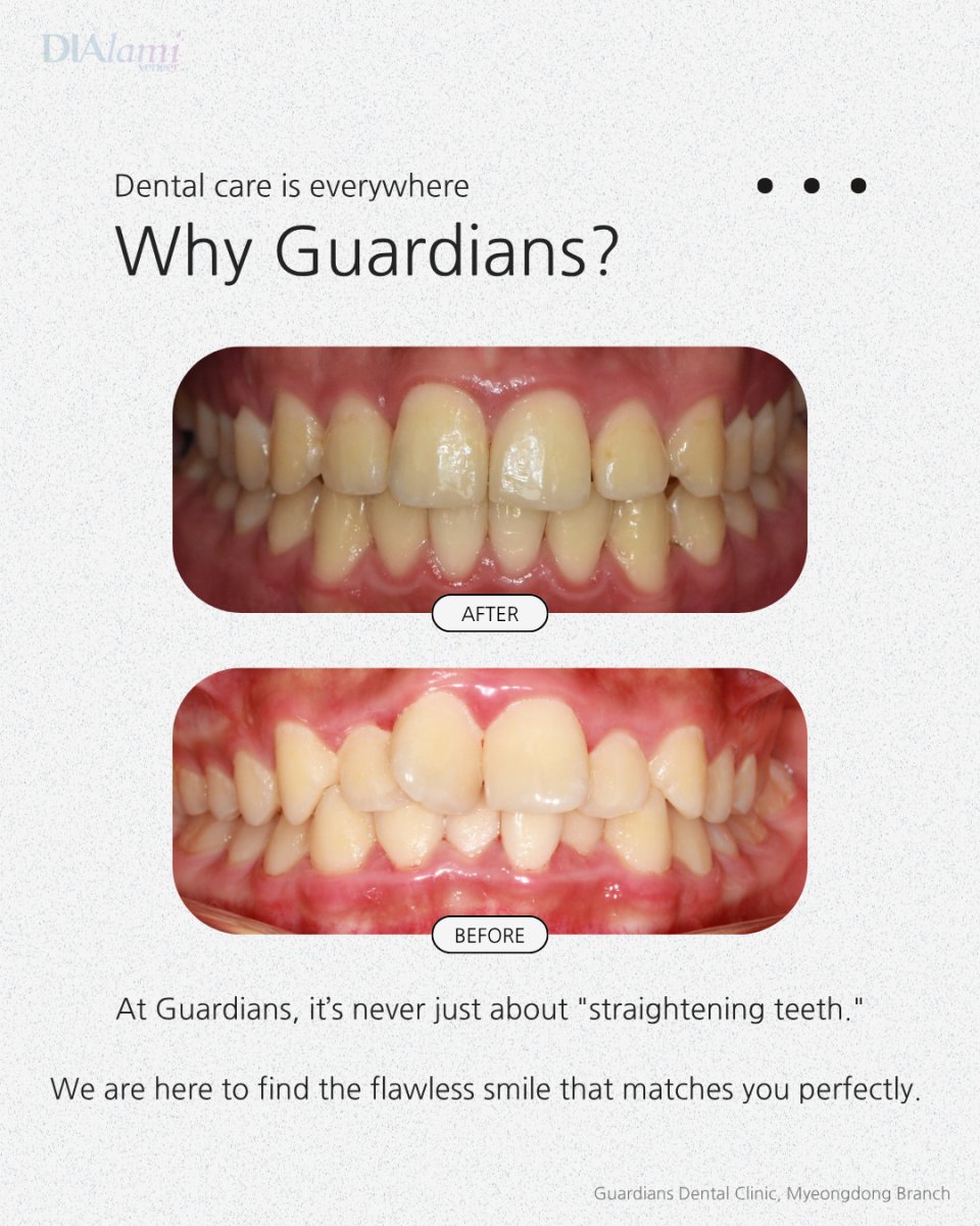 نتائج قبل وبعد تقويم الأسنان في Guardians Dental Clinic – تحسين انتظام الأسنان