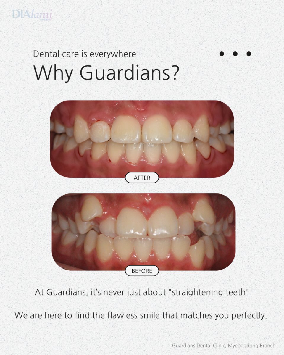 نتائج قبل وبعد تقويم الأسنان في Guardians Dental Clinic – تحسين انتظام الأسنان