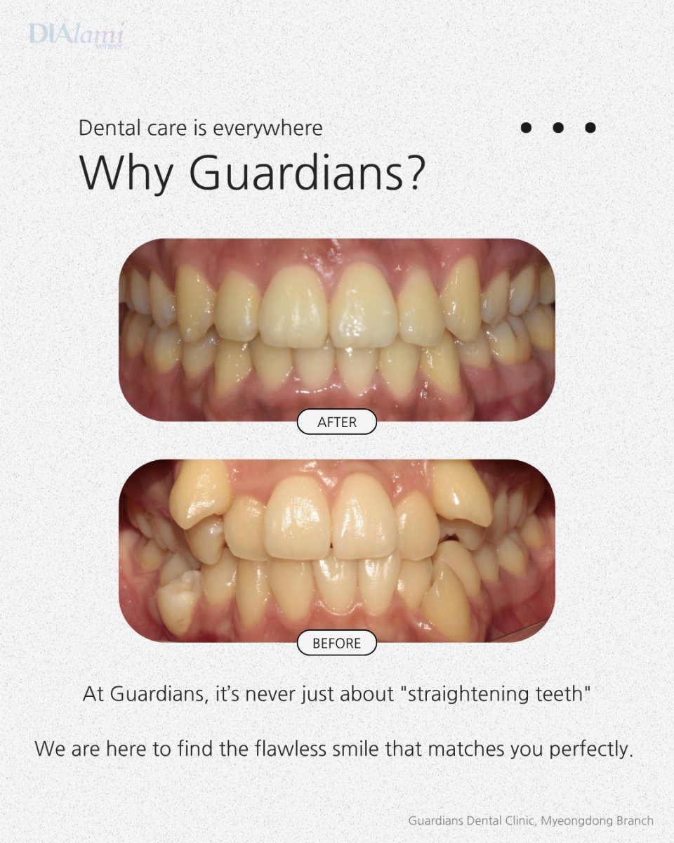 نتائج قبل وبعد تقويم الأسنان في Guardians Dental Clinic – تحسين انتظام الأسنان