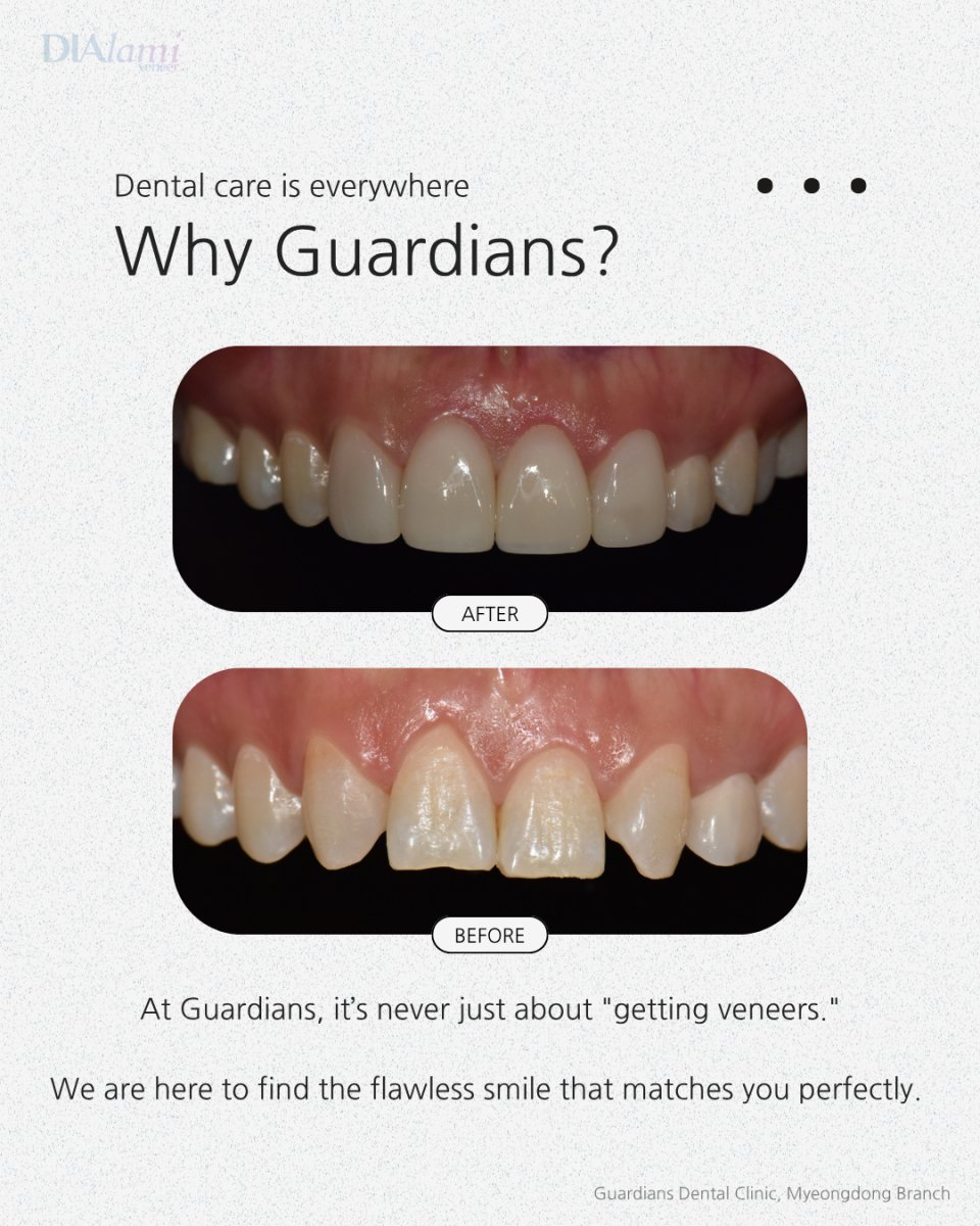 Before and after veneers result at Guardians Dental Clinic – smile transformation visible