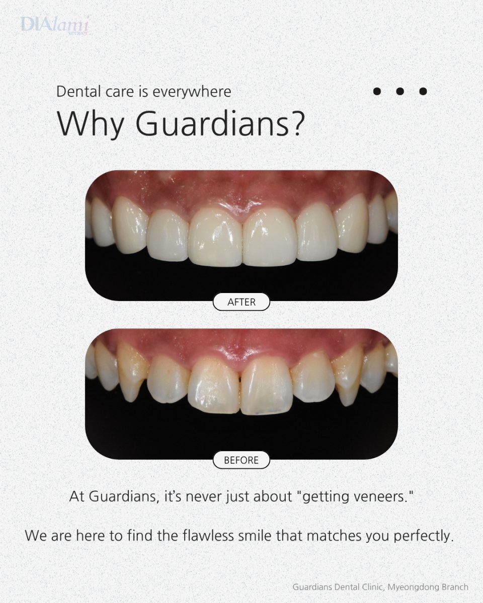 نتائج قبل وبعد الفينير في Guardians Dental Clinic – ابتسامة طبيعية محسنة