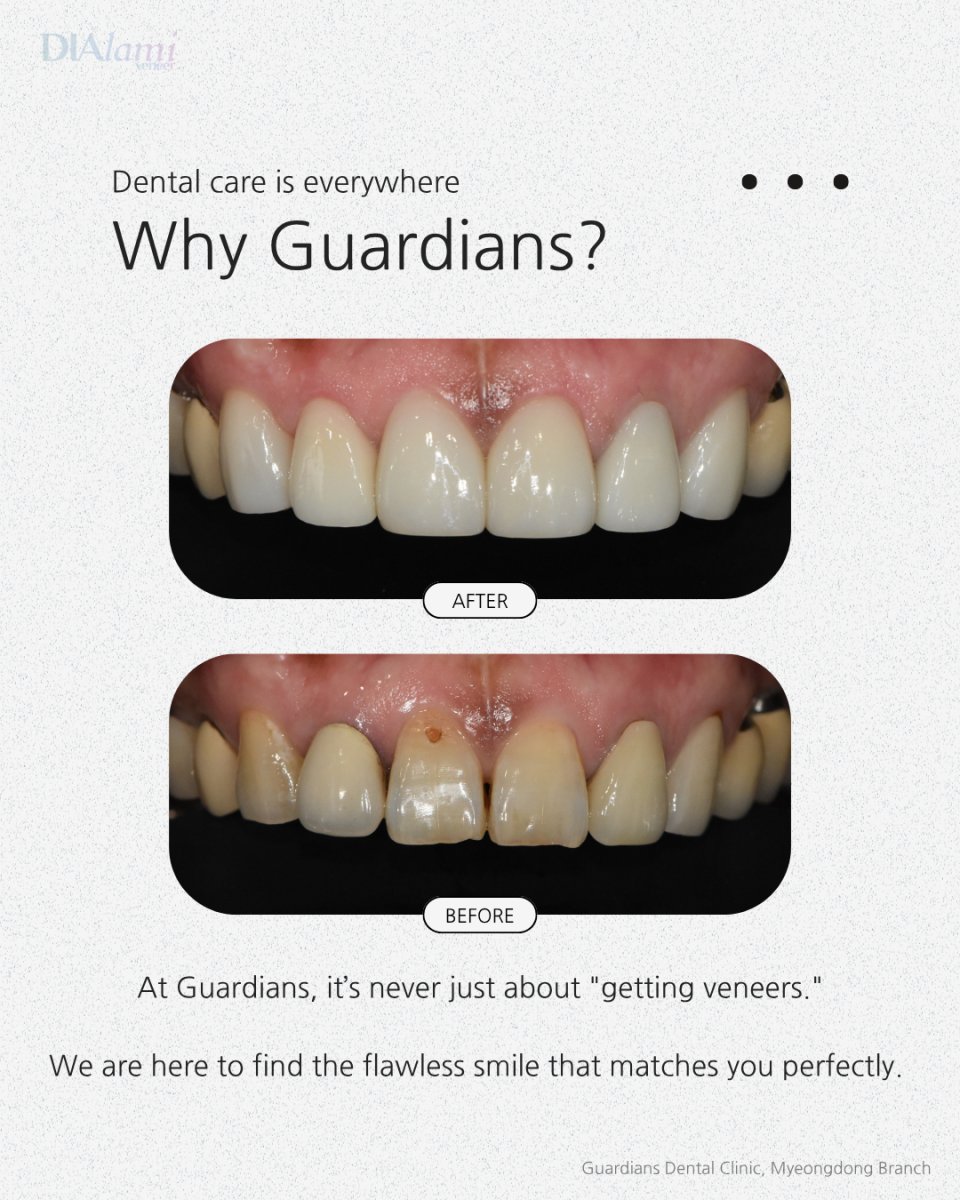 نتائج قبل وبعد الفينير في عيادة Guardians Dental – تحول الابتسامة