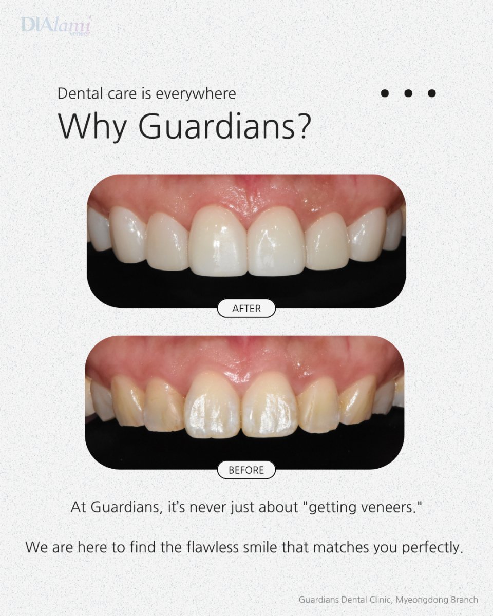 نتائج قبل وبعد الفينير في Guardians Dental Clinic – تحول ملحوظ في الابتسامة