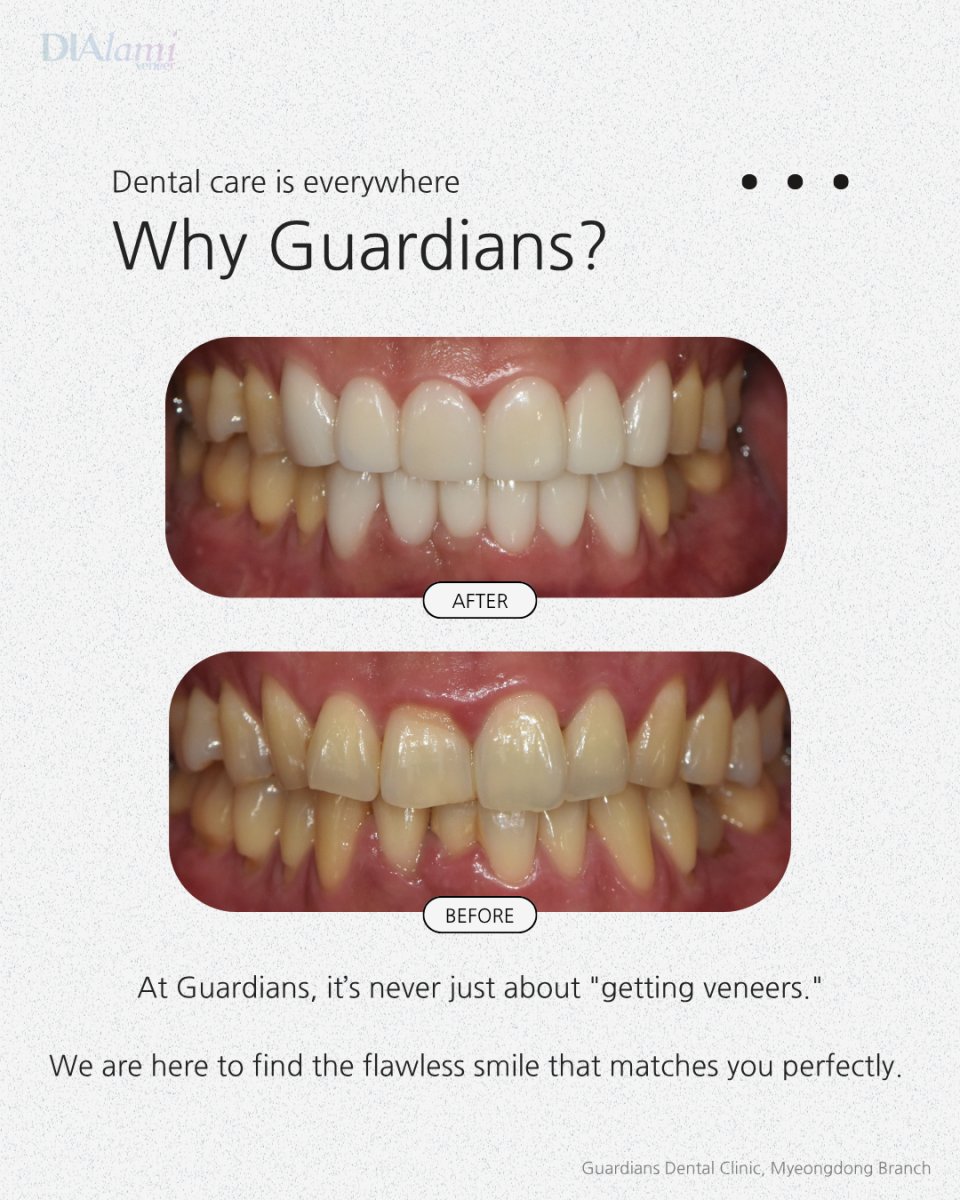 نتيجة قبل وبعد الفينير في Guardians Dental Clinic – تحول ملحوظ في الابتسامة