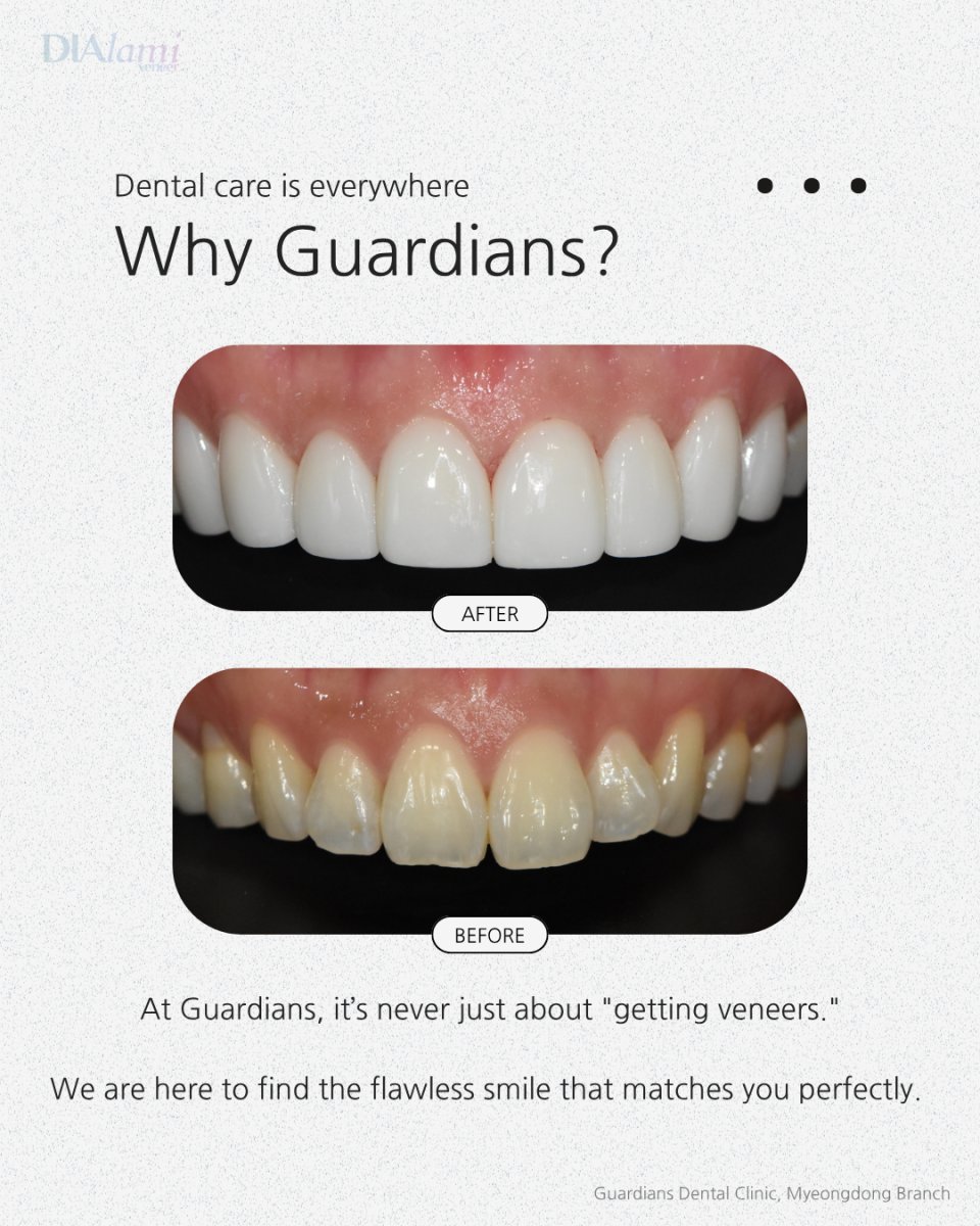 نتيجة قبل وبعد الفينير في Guardians Dental Clinic – ابتسامة محسنة وأسنان أكثر بياضًا
