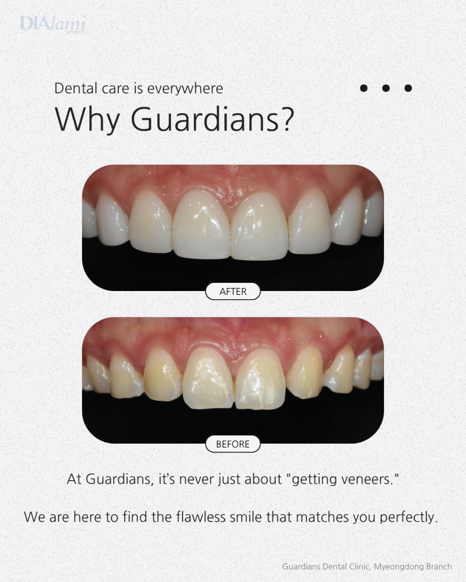 نتيجة قبل وبعد الفينير في Guardians Dental Clinic – ابتسامة محسنة وأسنان أكثر بياضًا