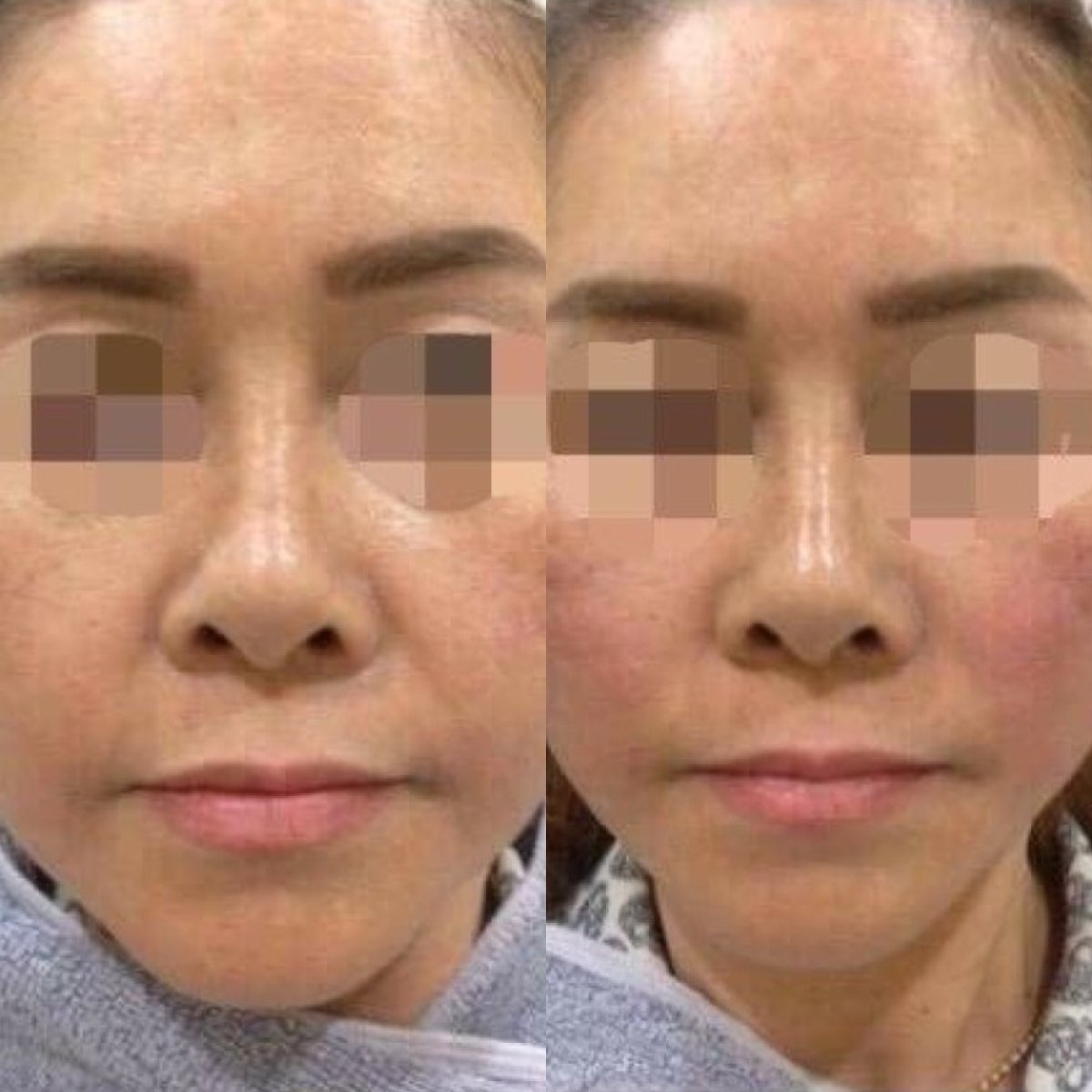 قبل وبعد حقن البوتوكس في ASIA CLINIC، تقليل التجاعيد ونعومة بشرة الوجه