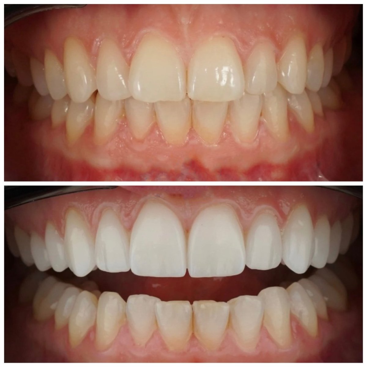 Resultados antes y después de carillas Emax en Nifa Dent International – transformación de sonrisa