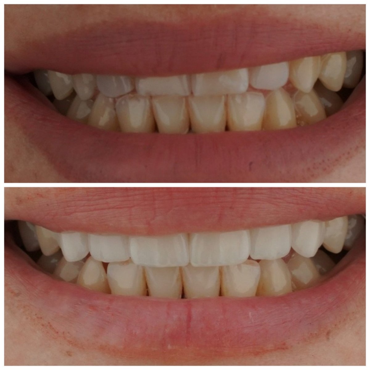 Antes y después de carillas Emax en Nifa Dent International: resultados de sonrisa transformada