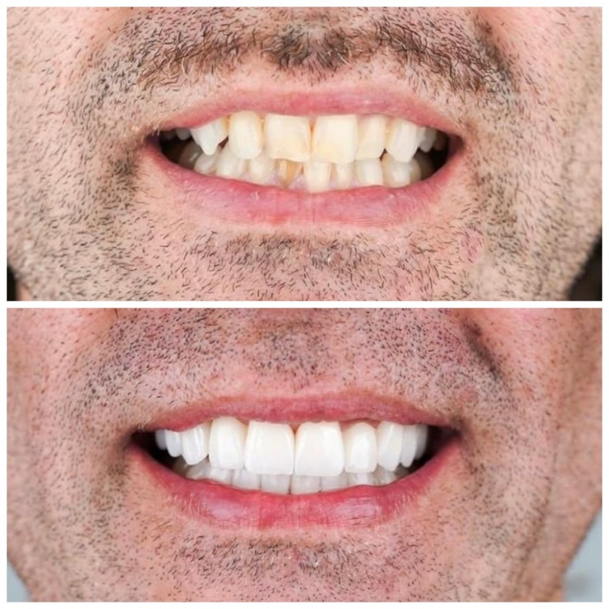 قبل وبعد الفينير في Nifa Dent International – تحول طبيعي للابتسامة