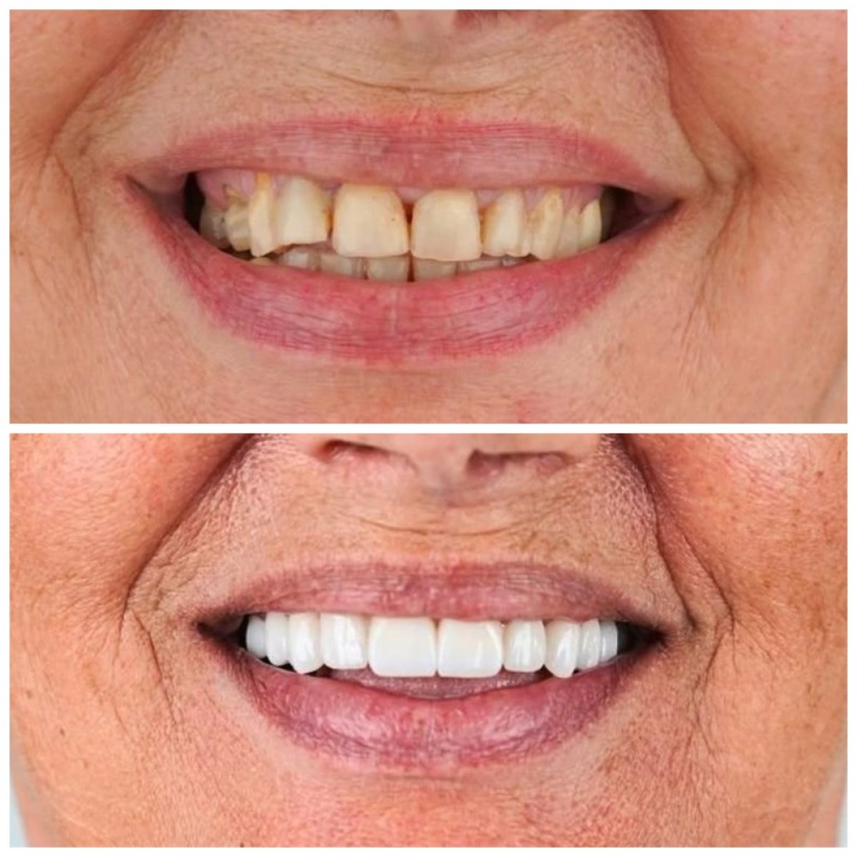 قبل وبعد الفينير في Nifa Dent International – نتائج تحول الابتسامة