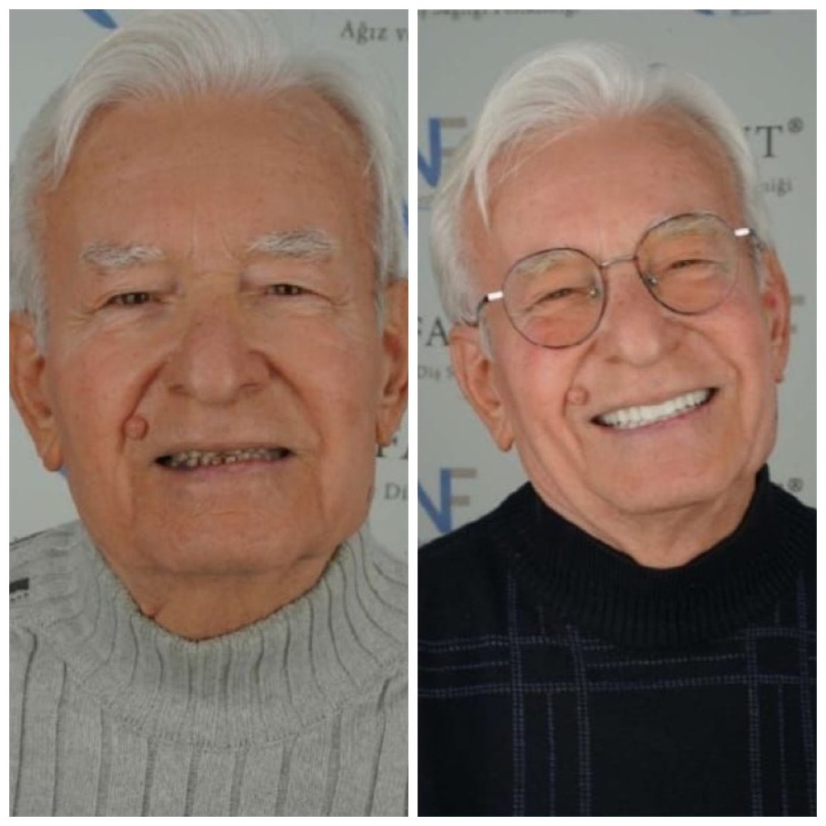 Before and after results of full-arch zirconia implant dentures at Nifa Dent International