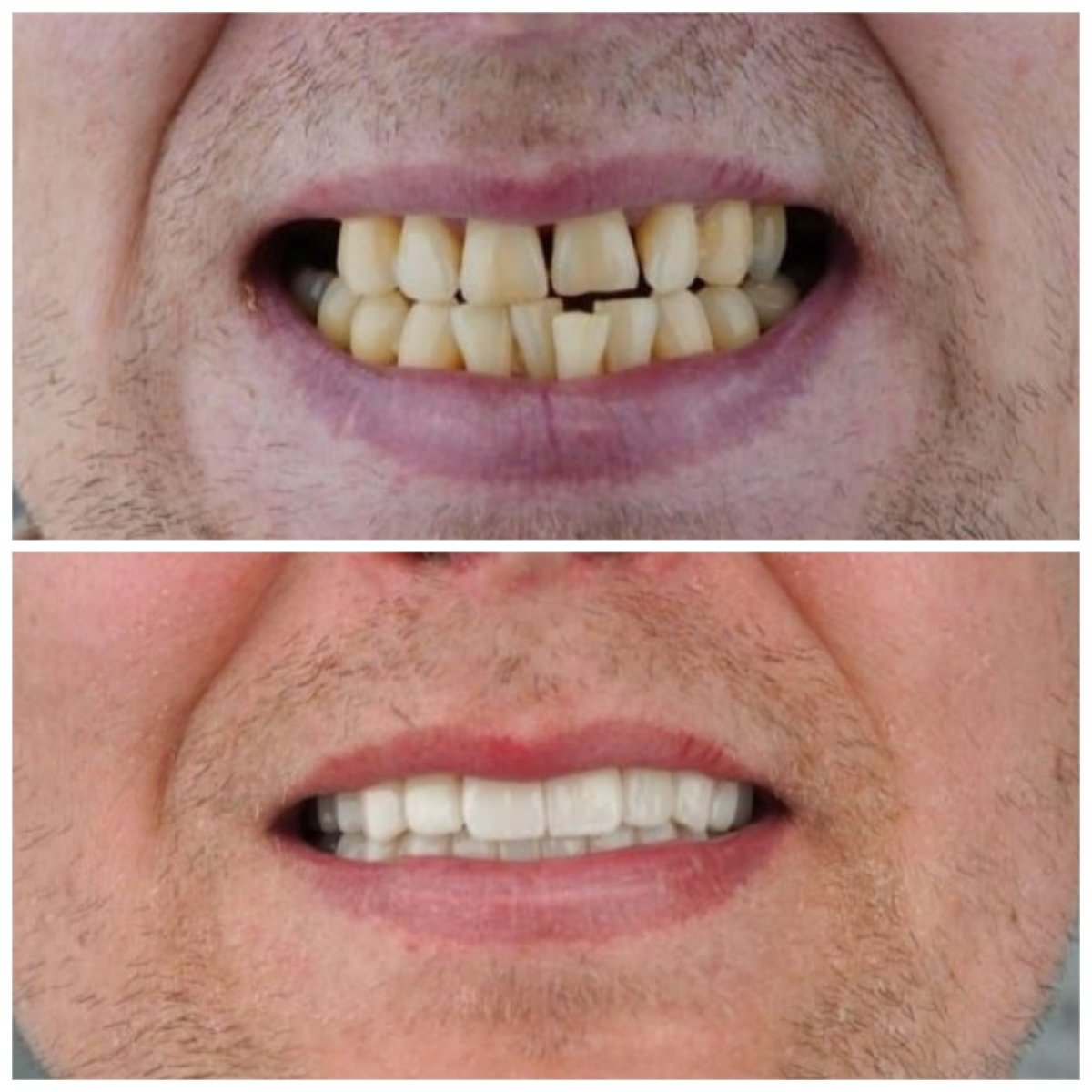 Resultados antes y después de prótesis de zirconia en Nifa Dent International