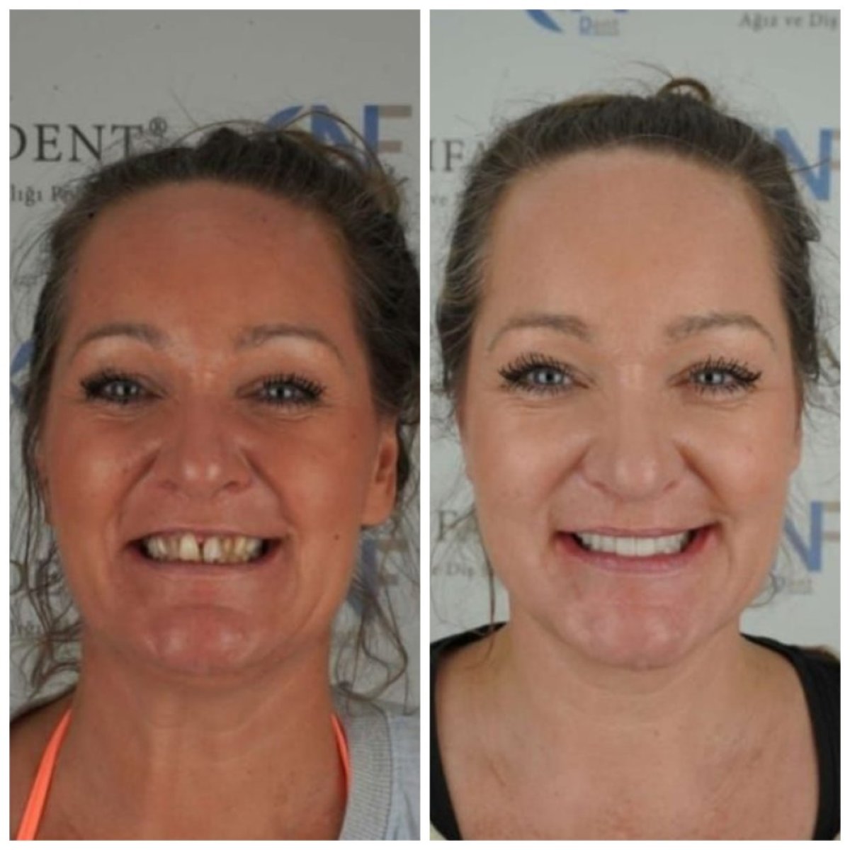 Resultados antes y después de prótesis fijas de zirconia en Nifa Dent International