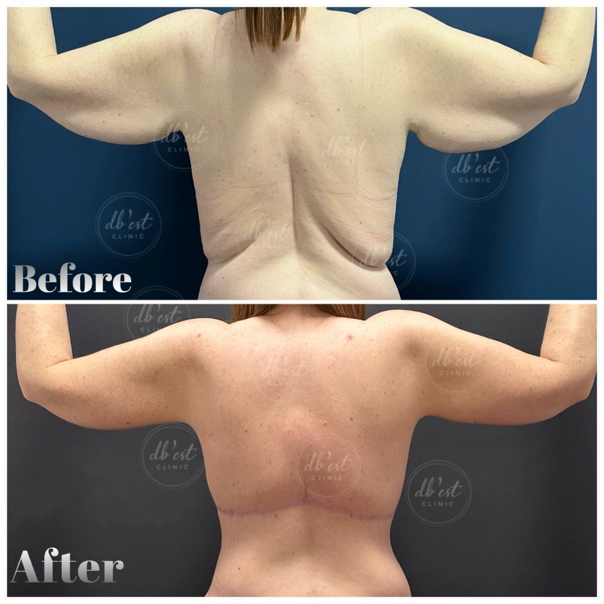 Before and after arm lift (brachioplasty) results at Db'est Clinic – improved arm contour