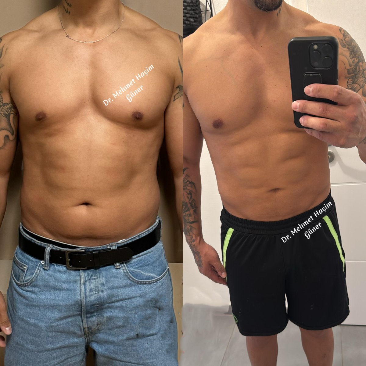 Vorher-nachher-Ergebnis Vaser-Liposuktion bei Dr. Mehmet Haşim Güner – definierte Bauchmuskeln