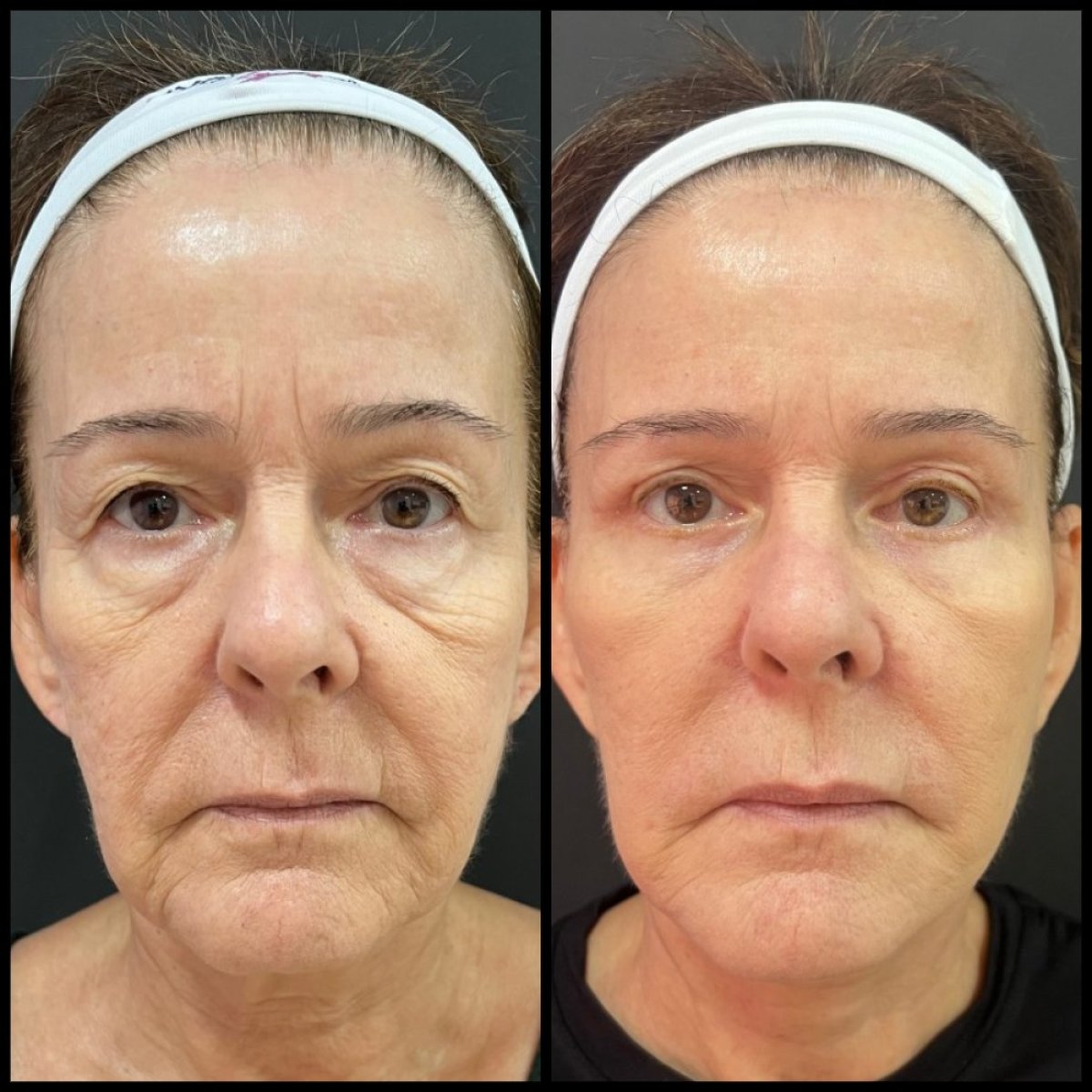 Resultados antes y después de deep plane facelift – rejuvenecimiento facial y menos arrugas