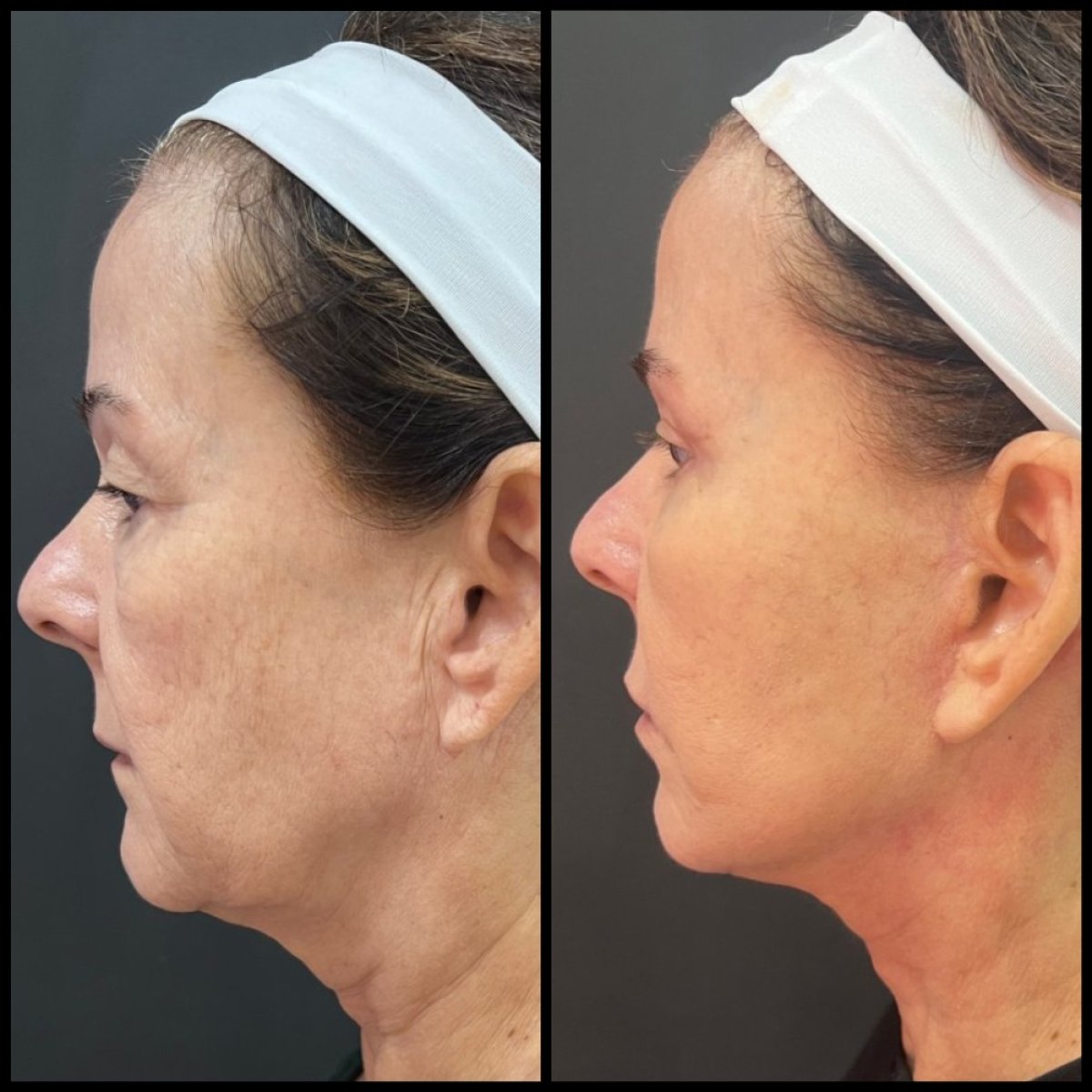 Resultados antes y después de deep plane facelift – rejuvenecimiento facial y mandíbula firme