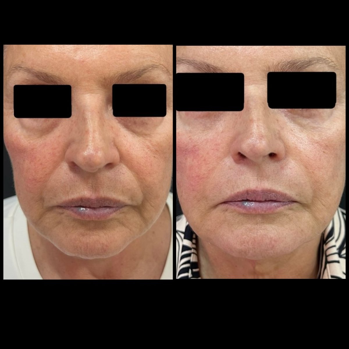 Resultados de blefaroplastia antes y después, corrección visible de párpados y rejuvenecimiento