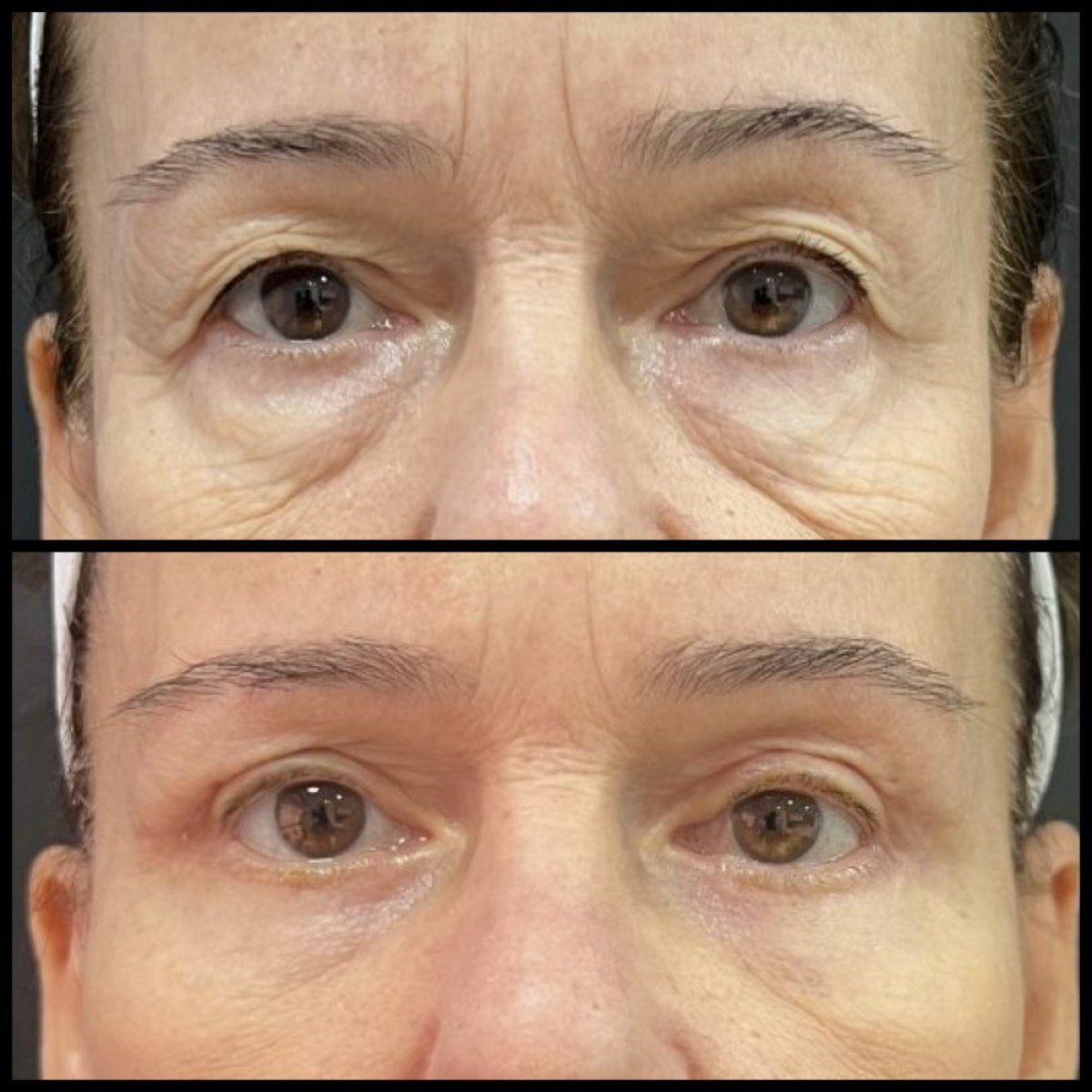 Resultados de blefaroplastia antes y después: menos párpados caídos y piel más lisa