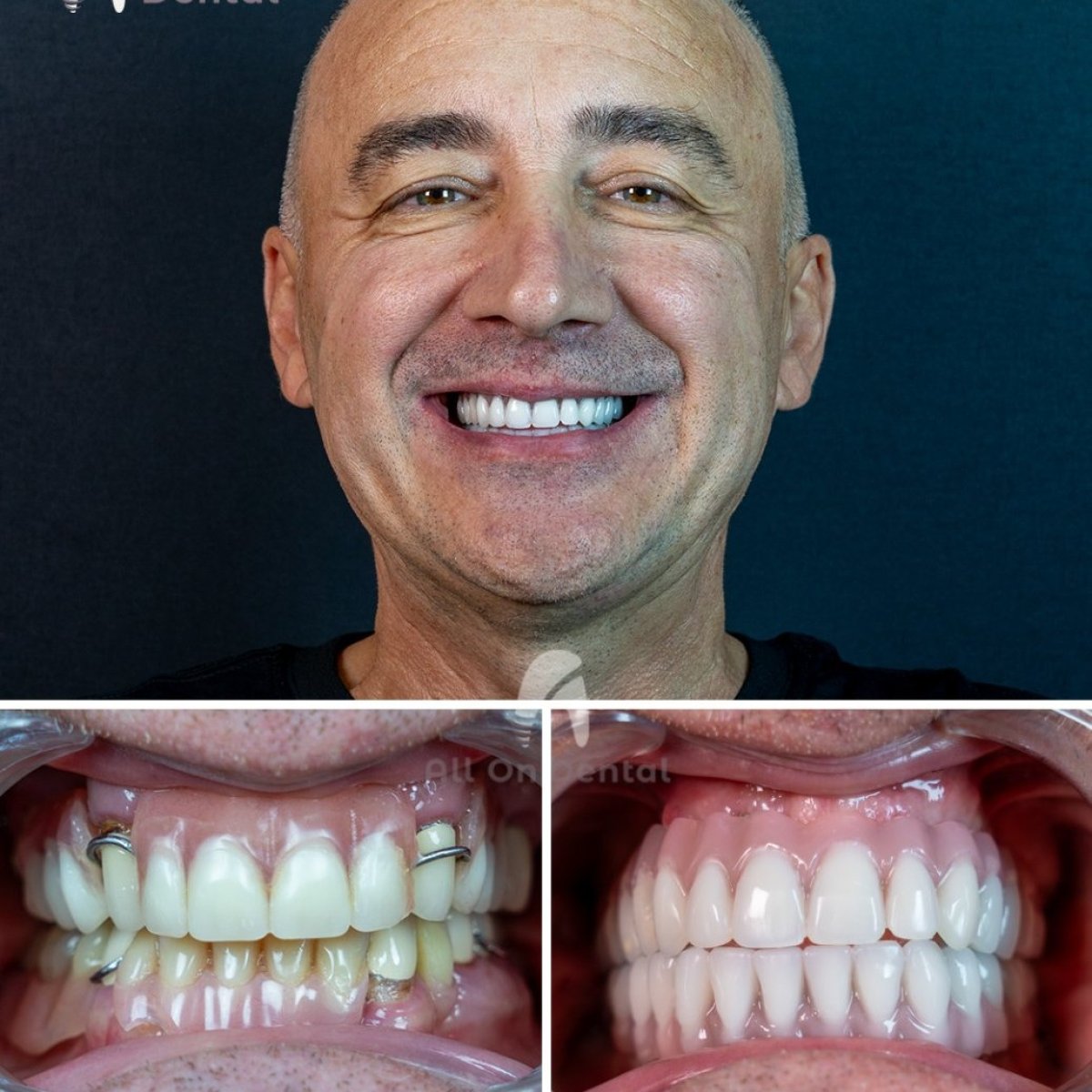 نتائج قبل وبعد زراعة الأسنان All-on-4 في All On Dental Istanbul، استعادة الابتسامة