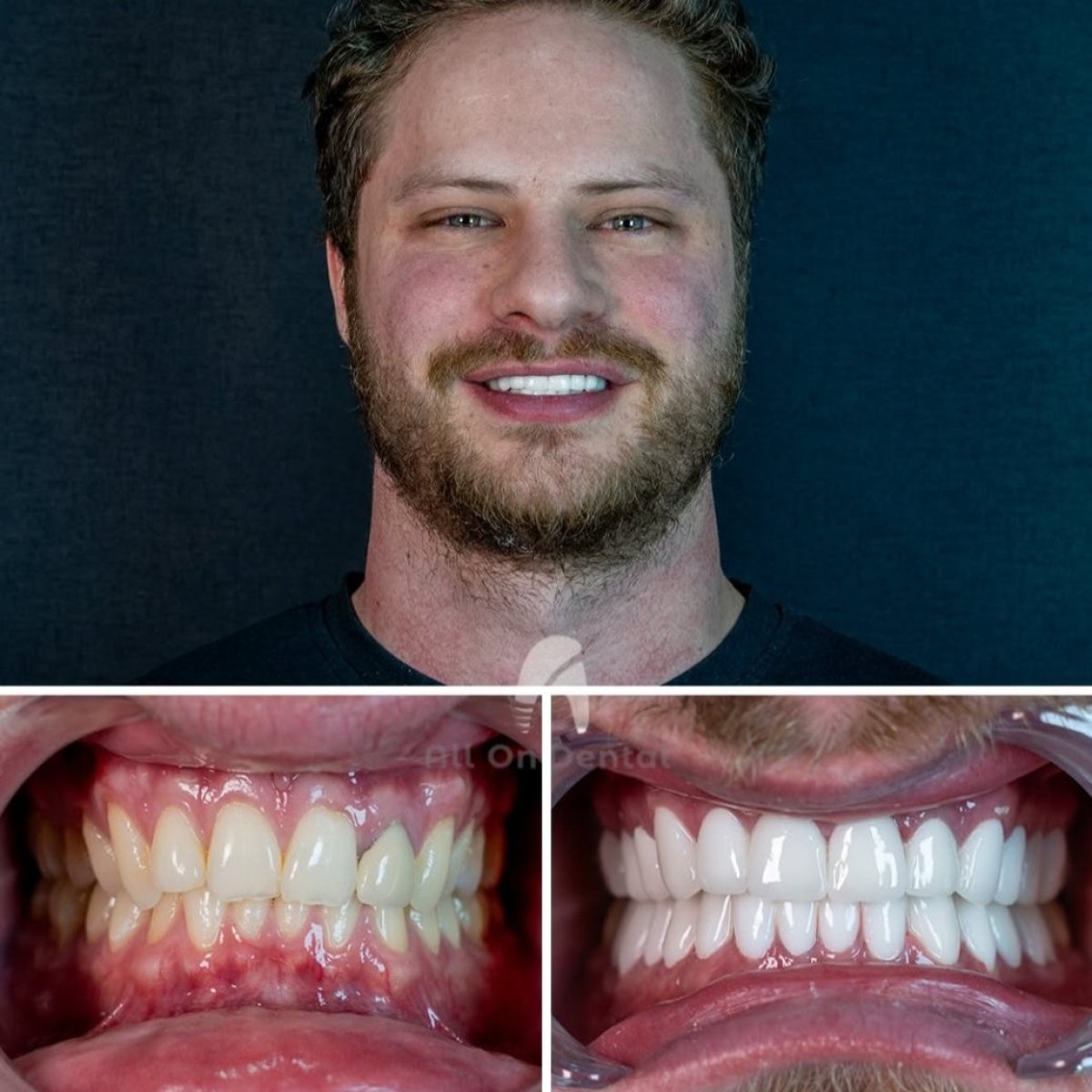 نتائج قبل وبعد تركيب تيجان الأسنان في All On Dental Istanbul، ابتسامة محسنة
