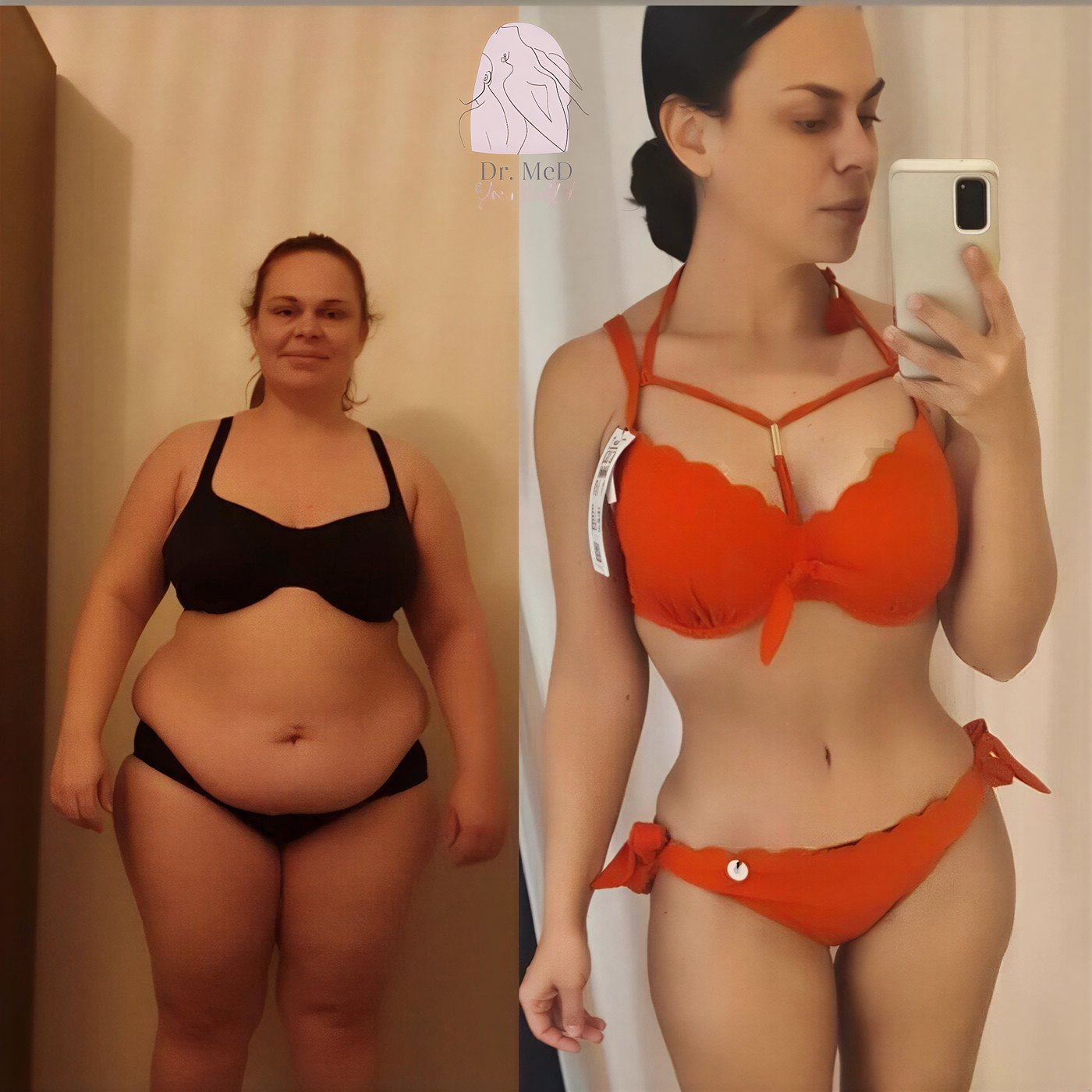 Resultados de abdominoplastia y liposucción antes y después en Dr. MED – contorno visible