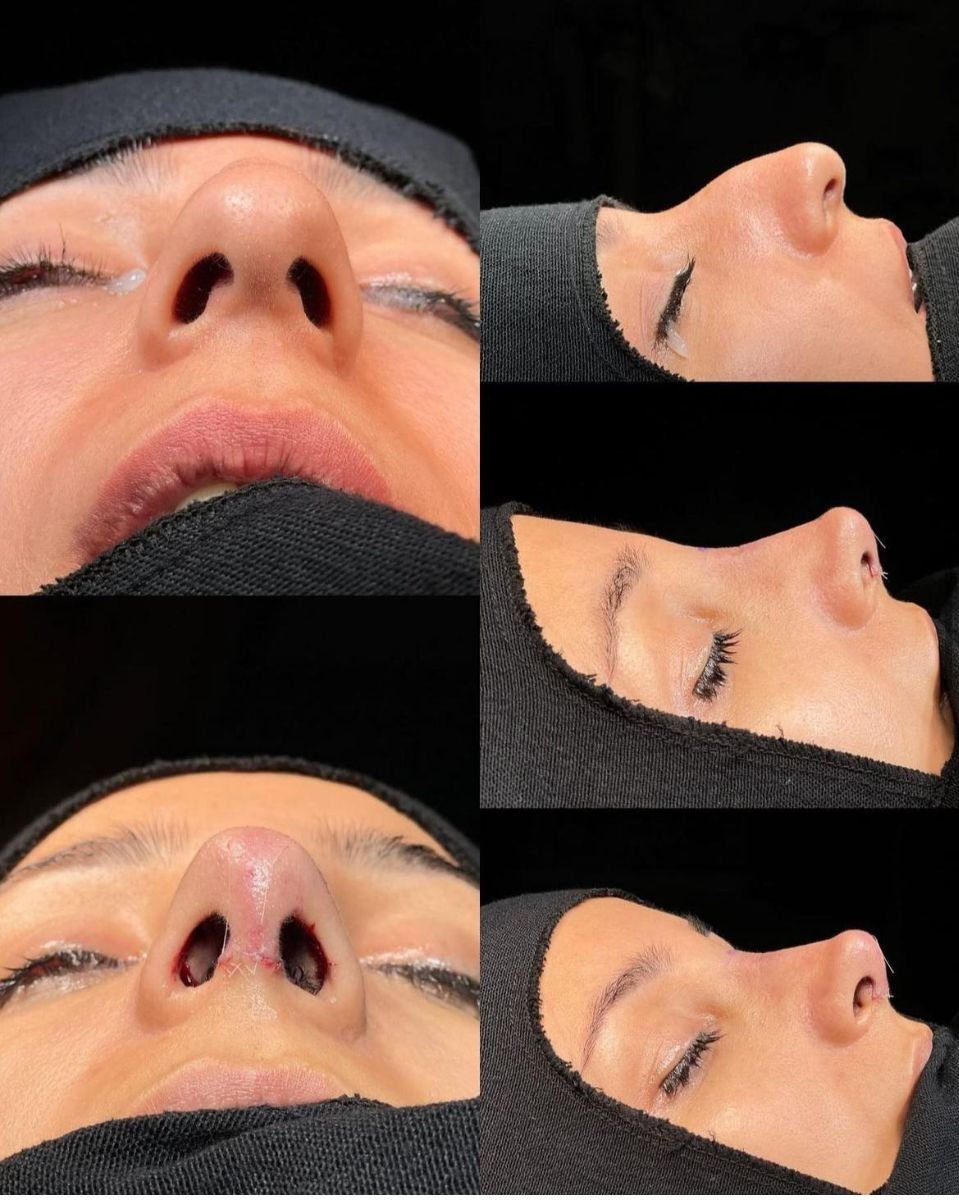 نتائج تجميل الأنف قبل وبعد في مستشفى Memorial Bahçelievler، إعادة تشكيل الأنف