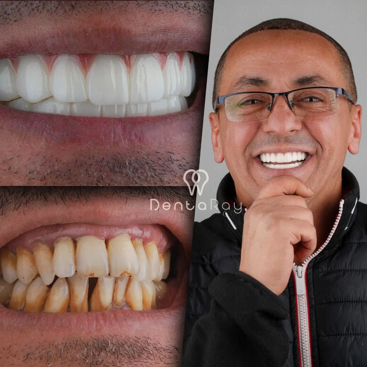 Résultats avant/après Hollywood Smile à Dentaray Clinic – facettes dentaires