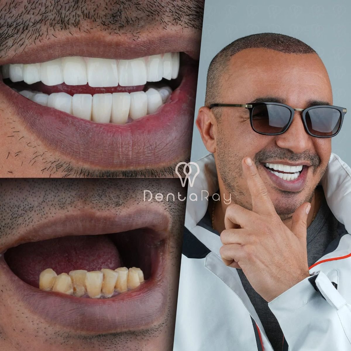 نتائج قبل وبعد ابتسامة هوليود في عيادة Dentaray – ابتسامة فينيرز
