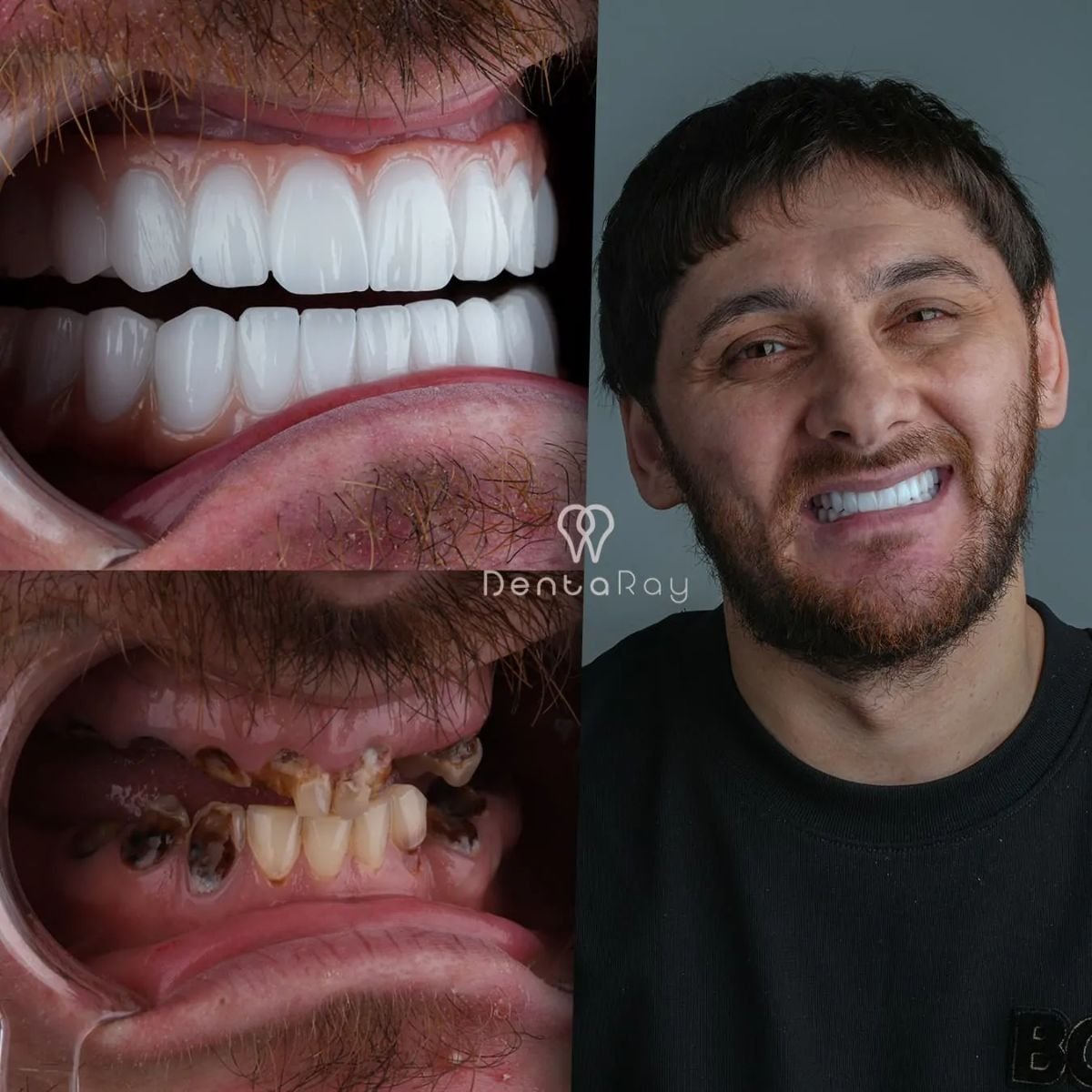 نتائج قبل وبعد ابتسامة هوليود في عيادة Dentaray – ترميم كامل للأسنان