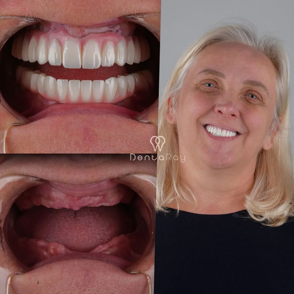 نتائج قبل وبعد زراعة الأسنان في عيادة Dentaray – استعادة الابتسامة بالكامل