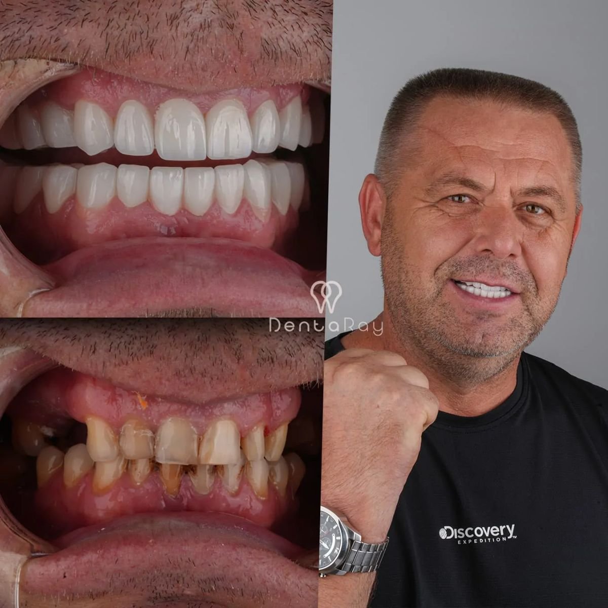 Résultats avant/après implant dentaire à la clinique Dentaray – sourire restauré