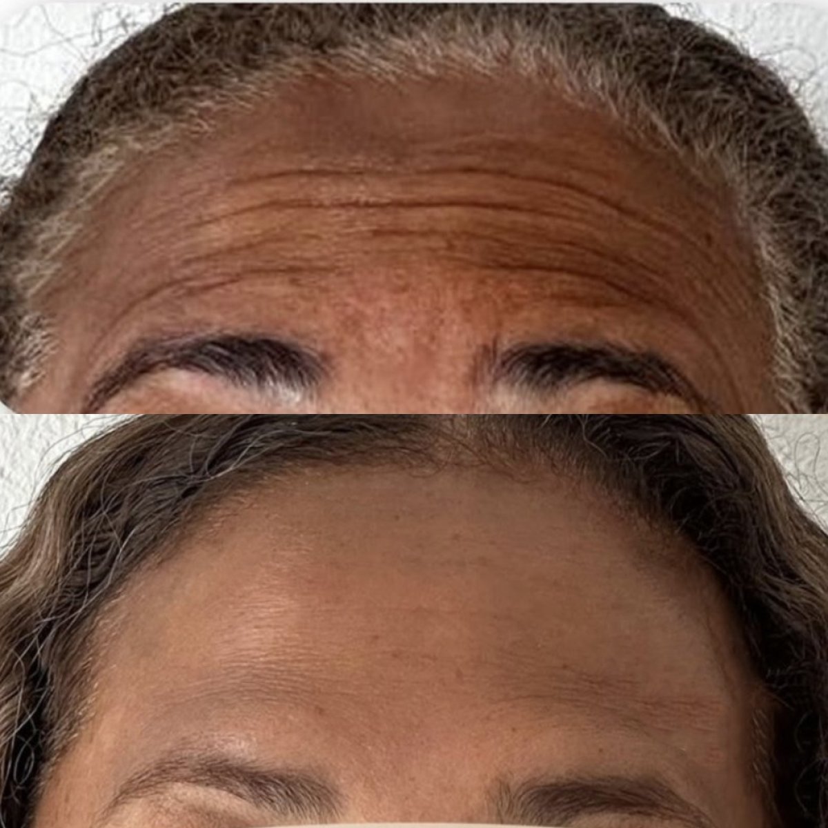 تقليل تجاعيد الجبهة قبل وبعد البوتوكس في Punta Cana dentist odontologia familiar