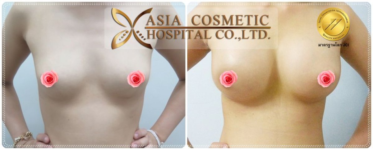 Resultados antes y después de revisión de implantes mamarios en Asia Cosmetic Hospital