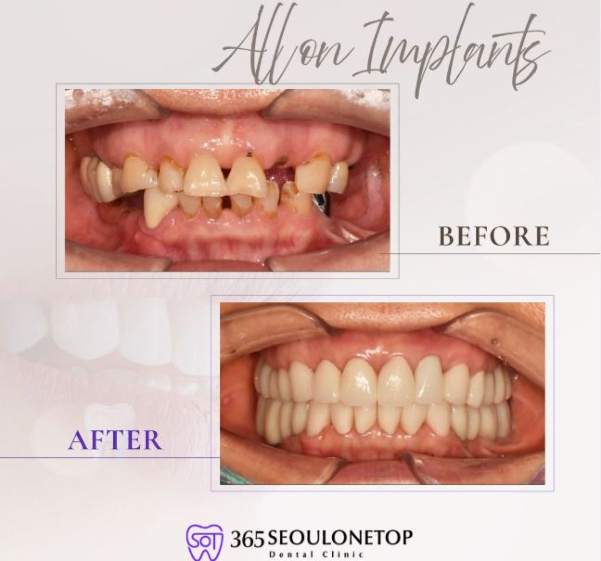 نتيجة قبل وبعد زراعة أسنان All-on-4 في 365 Seoul OneTop Dental Clinic، ابتسامة مستعادة